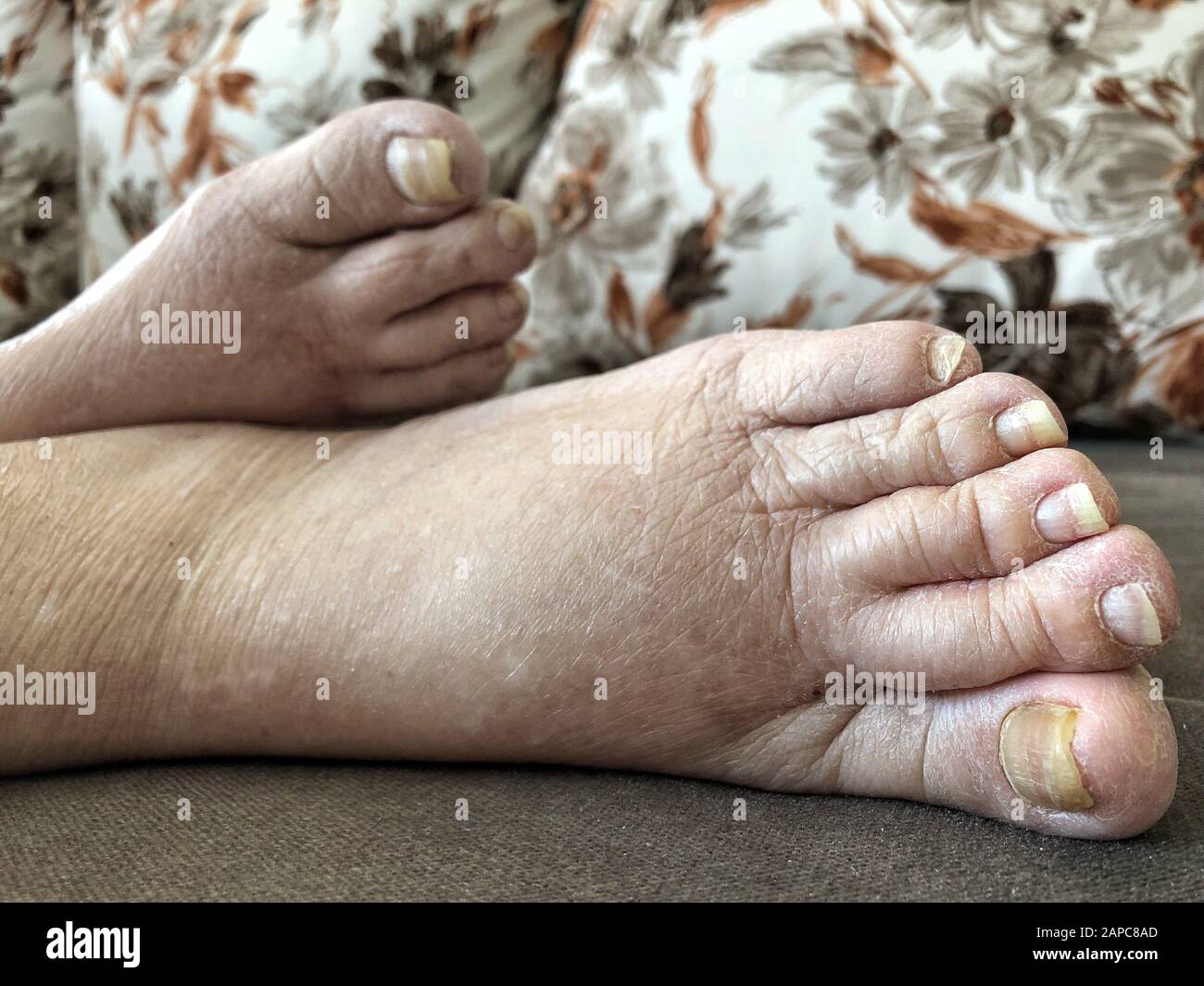 pieds d'un patient qui a un œdème pulmonaire avec des ongles endommagés à cause de champignon et d'athlète Banque D'Images
