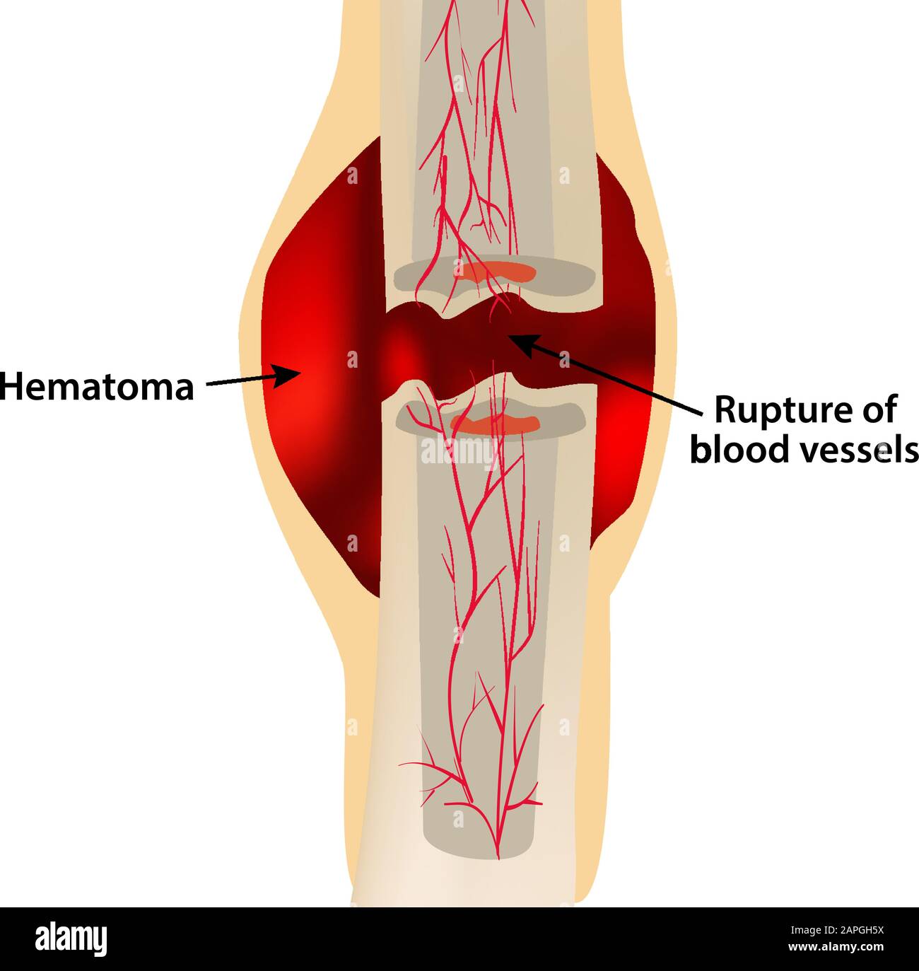 1 Étape De La Fracture De L'Os De Guérison. Formation de callus. Hématome. La fracture osseuse. Infographies. Illustration vectorielle sur un arrière-plan isolé. Illustration de Vecteur