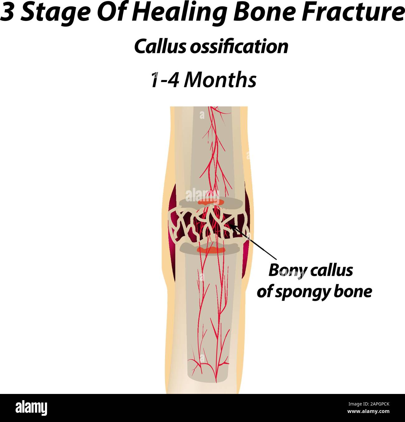 3 étape De guérison Fracture d'os. Ossification de callus. La fracture osseuse. Infographies. Illustration vectorielle sur un arrière-plan isolé. Illustration de Vecteur