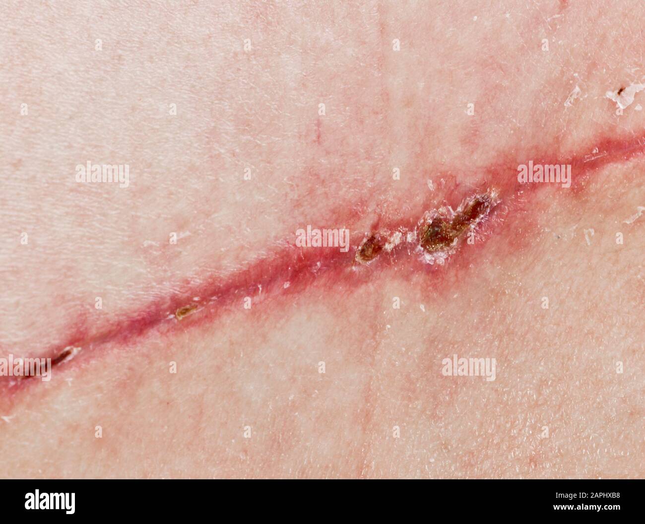 Une couture après la chirurgie sur la peau du dos d’une personne. Transplantation chirurgicale d'un lambeau musculaire du dos. Fils auto-absorbables cousus, Banque D'Images