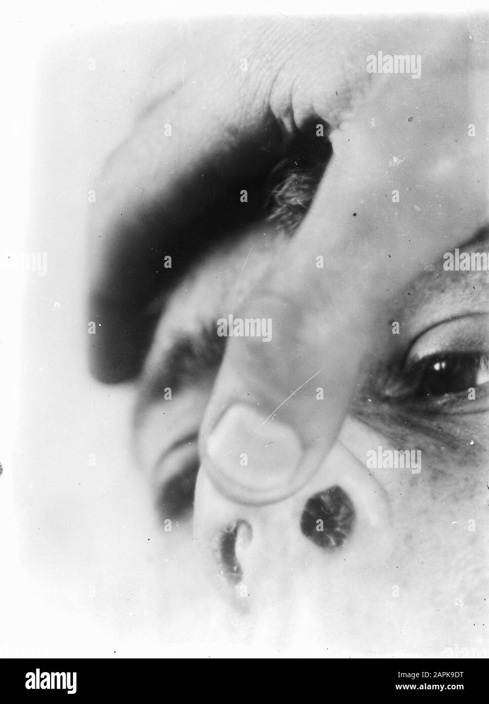 Maladies nasales Banque d'images noir et blanc - Alamy