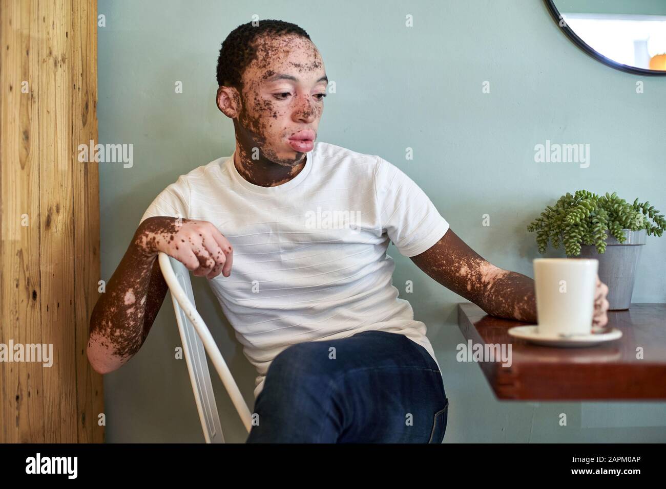 Jeune homme avec vitiligo ayant une tasse de café dans une cafétéria Banque D'Images