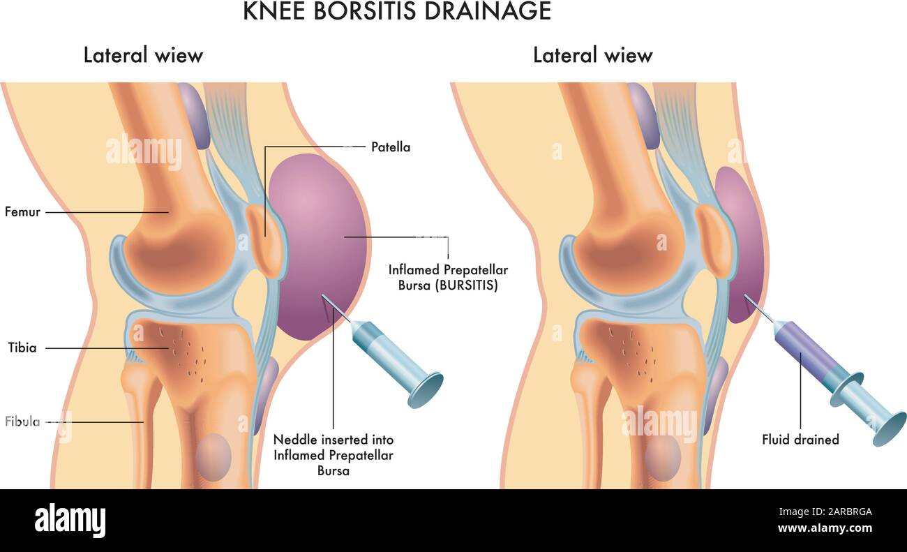 Illustration médicale marquée montrant la procédure de drainage de la bursite du genou. Illustration de Vecteur
