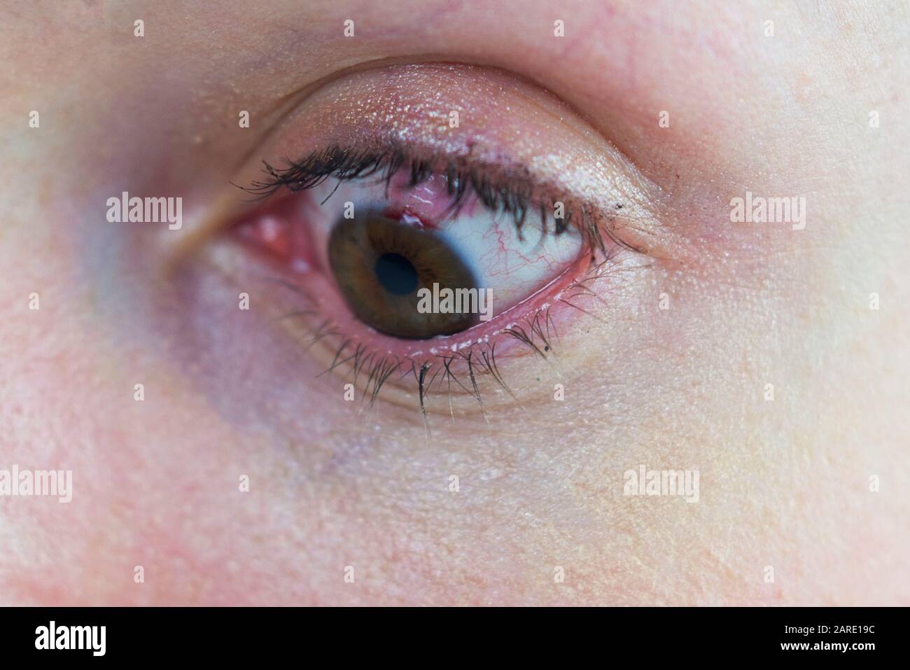 Œil avec une sclérera sanglante de dommages de chirurgie de l'œil laser. Cellules sanguines dans les yeux, sang visiteux. Maquillage portant une femme Banque D'Images