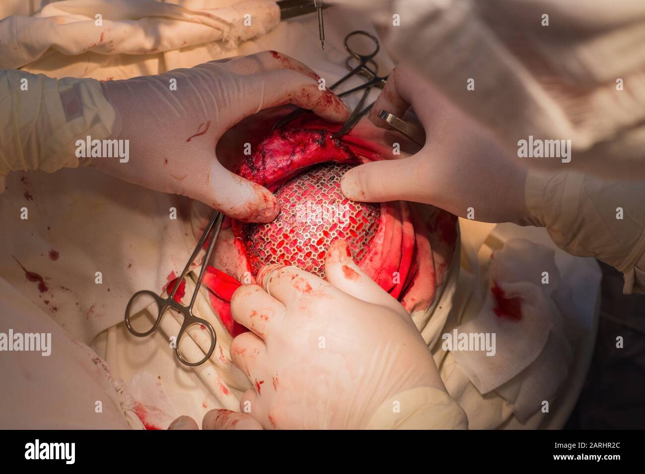 vue de dessus, étapes de la chirurgie neurochirurgicale pour l'installation d'une plaque en titane dans le crâne du patient. Neurochirurgie pédiatrique. Craniotomie. Incision des s Banque D'Images