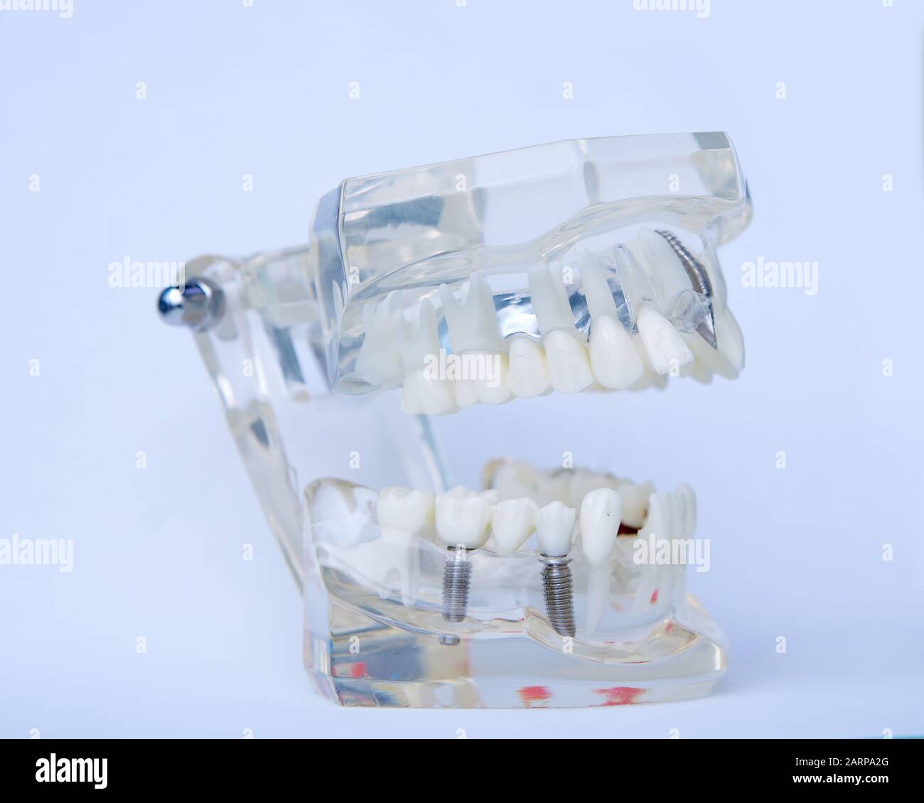 Modèle en plastique avec dent dentiste implant vis pour l'enseignement,  l'apprentissage et les patients en cabinet dentaire montrant les dents et  les gencives Photo Stock - Alamy
