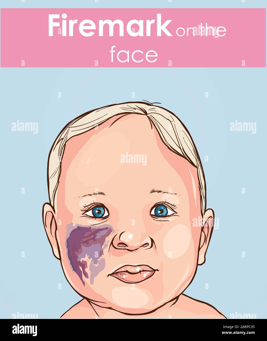 Illustration vectorielle d'une marque de feu sur le visage du bébé. Illustration de Vecteur