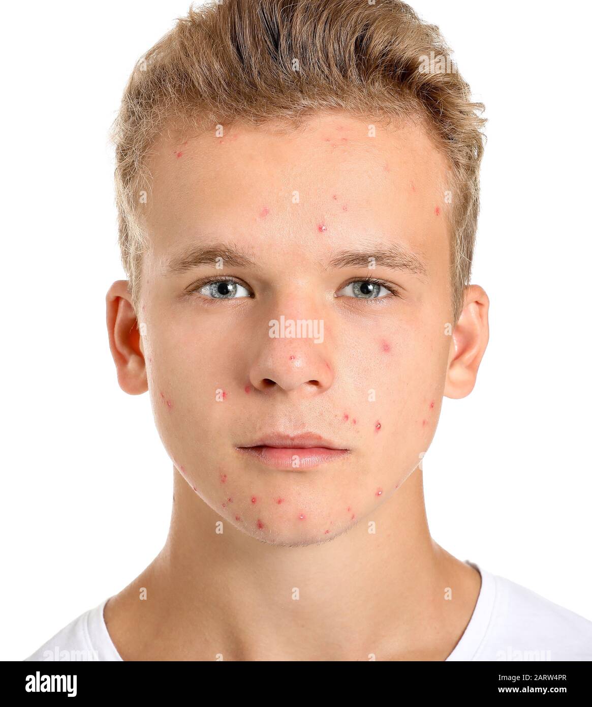 Adolescent garçon avec problème d'acné sur fond blanc Banque D'Images