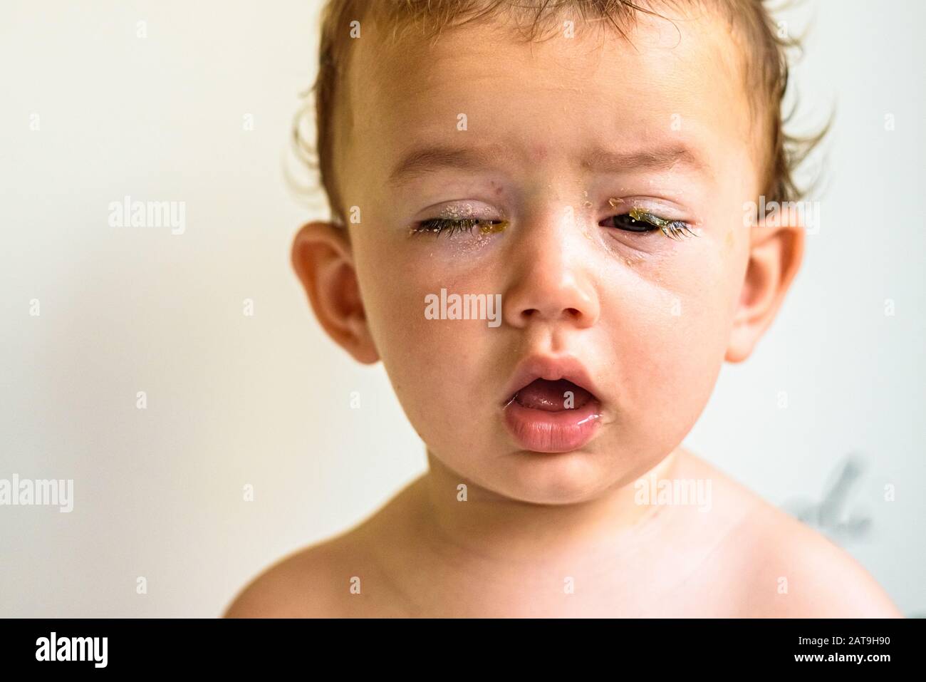 Yeux D Un Bebe Atteint De Conjonctivite Bacterienne Purulence Photo Stock Alamy
