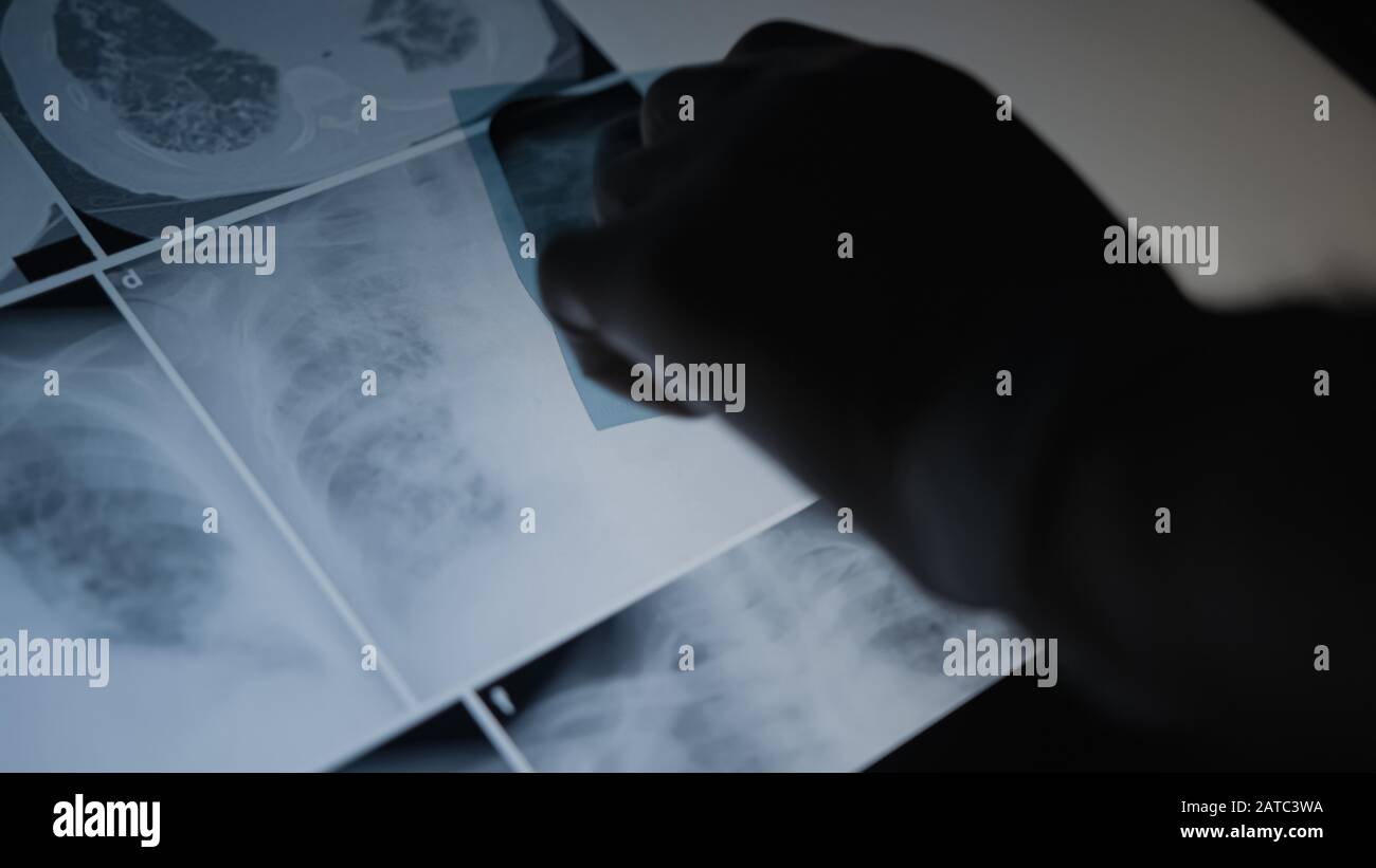 Concept de radiographie pulmonaire. Médecin en radiologie examinant sur la poitrine du film radiographique du patient dans la salle d'hôpital. Concept Médical. Banque D'Images