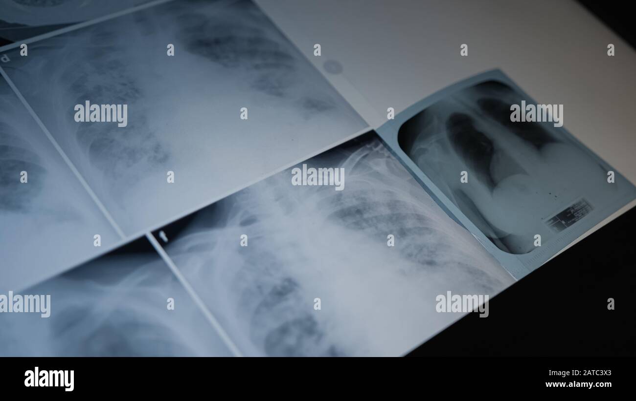 Concept de radiographie pulmonaire. Médecin en radiologie examinant sur la poitrine du film radiographique du patient dans la salle d'hôpital. Concept Médical. Banque D'Images