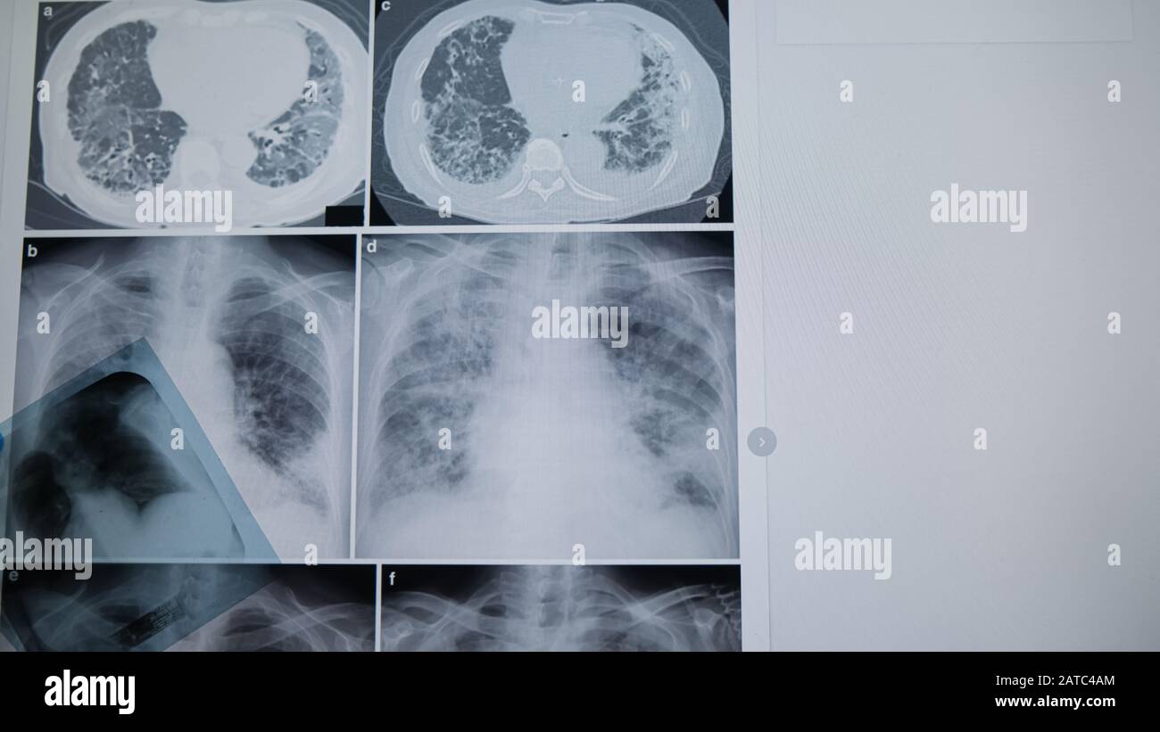 Concept de radiographie pulmonaire. Médecin en radiologie examinant sur la poitrine du film radiographique du patient dans la salle d'hôpital. Concept Médical. Banque D'Images