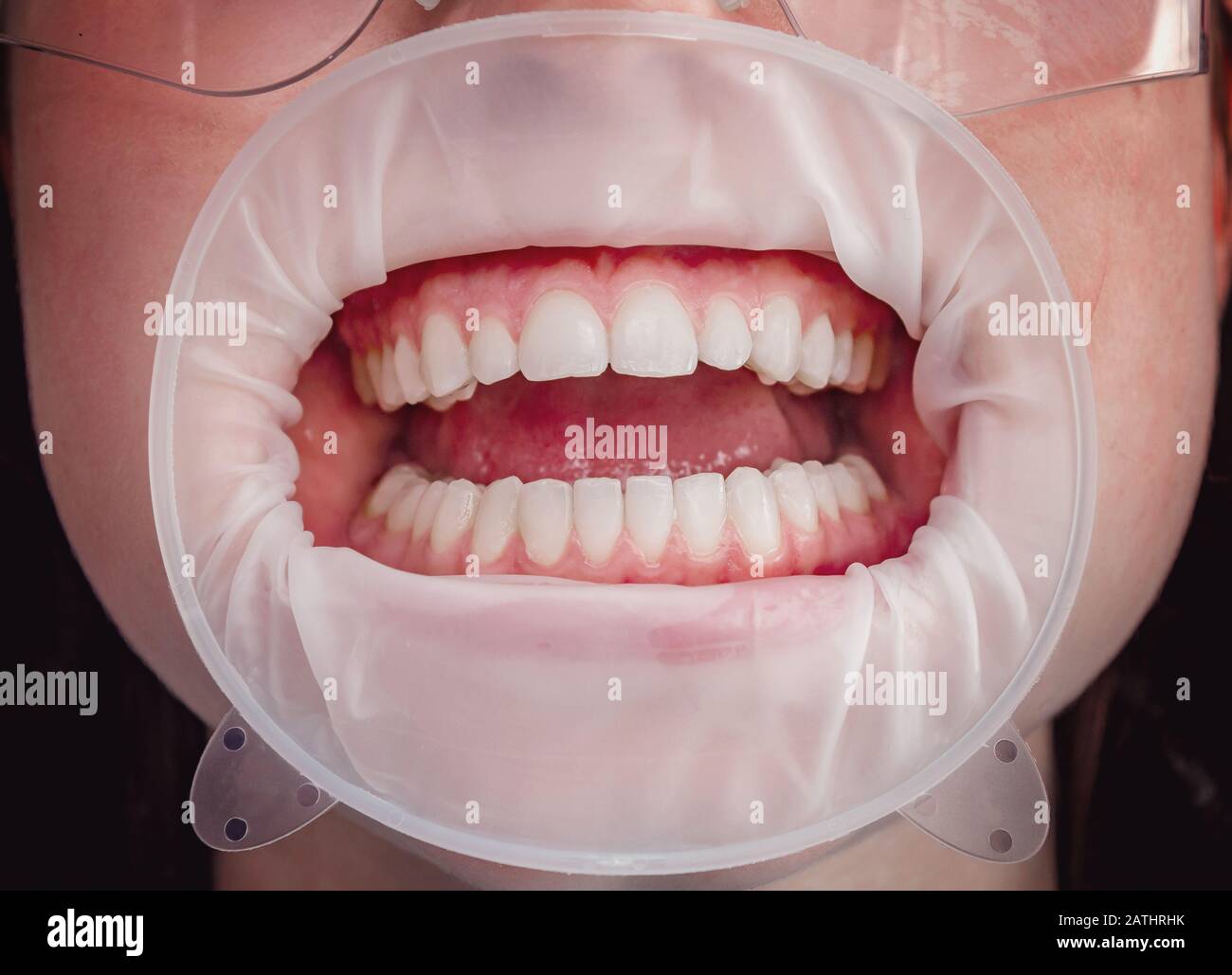 Dents dans la bouche à la clinique dentaire, la bouche est ouverte avec un écarteur de joue Banque D'Images Dents dans la bouche à la clinique dentaire, la bouche est ouverte avec un écarteur de joue Banque D'Images
