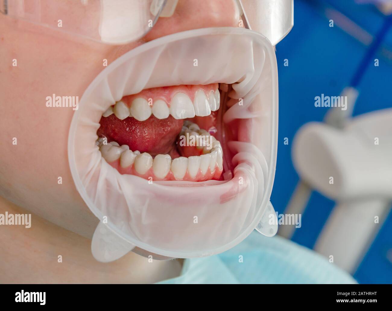 écarteur de bouche Banque de photographies et d’images à haute