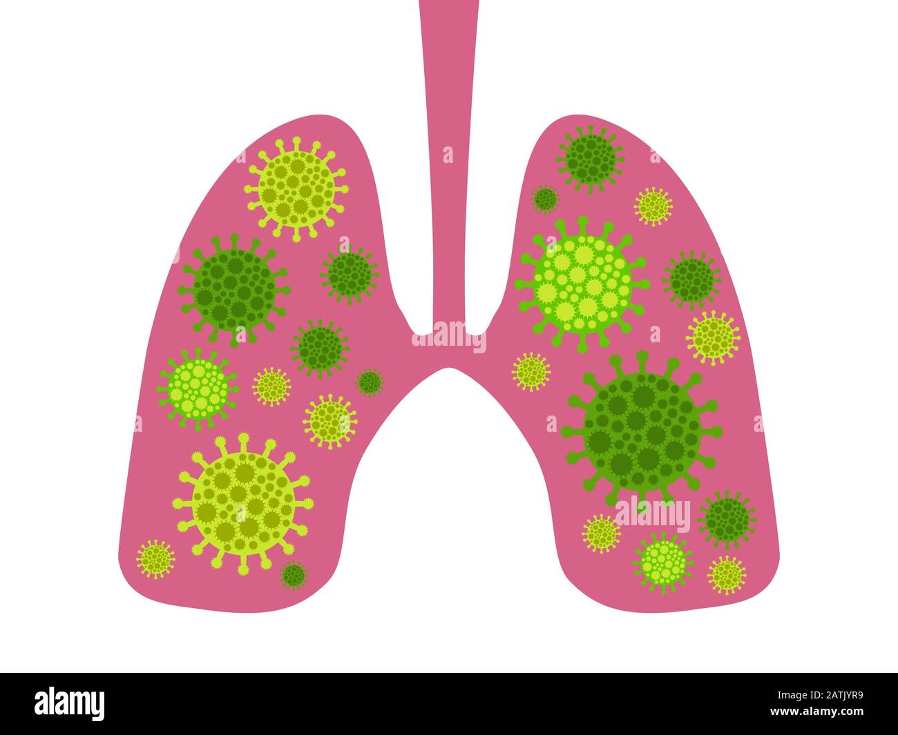 Infection dans les poumons. Coronavirus 2019-nCoV, syndrome respiratoire du Moyen-Orient. Illustration vectorielle Illustration de Vecteur