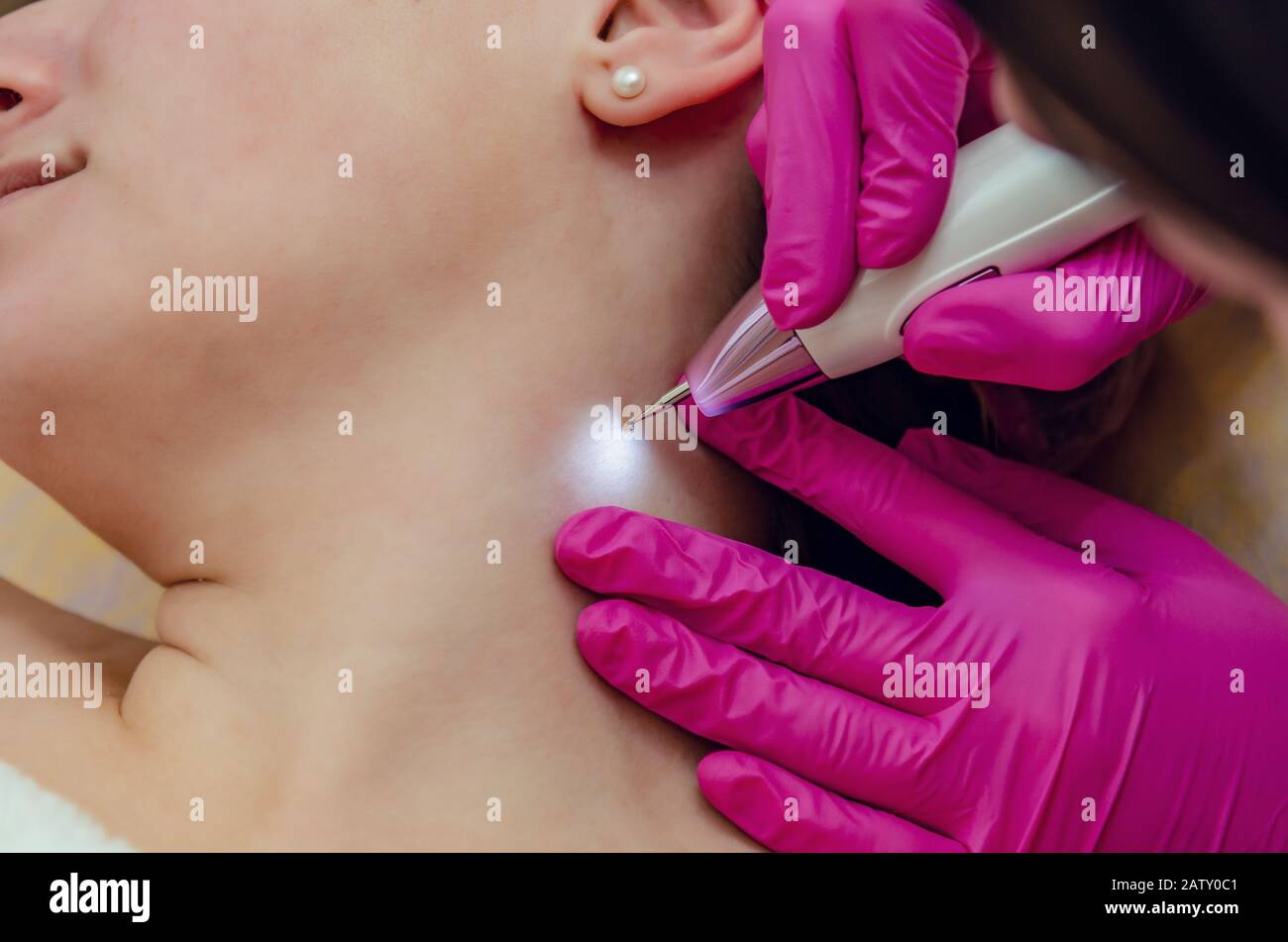 Retrait des papillomes sur le cou dans un salon de beauté. Banque D'Images