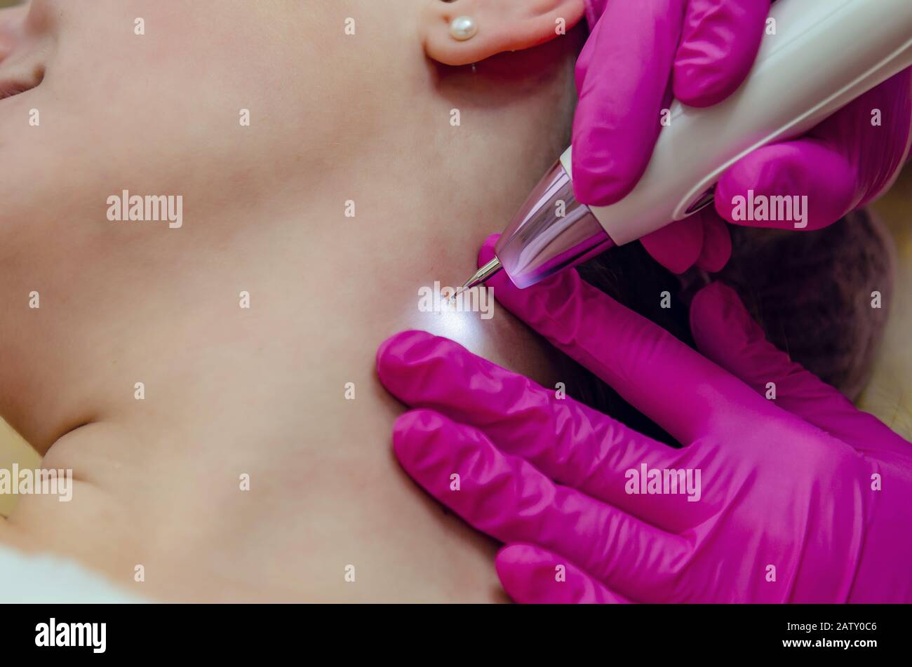 Retrait des papillomes sur le cou dans un salon de beauté. Banque D'Images