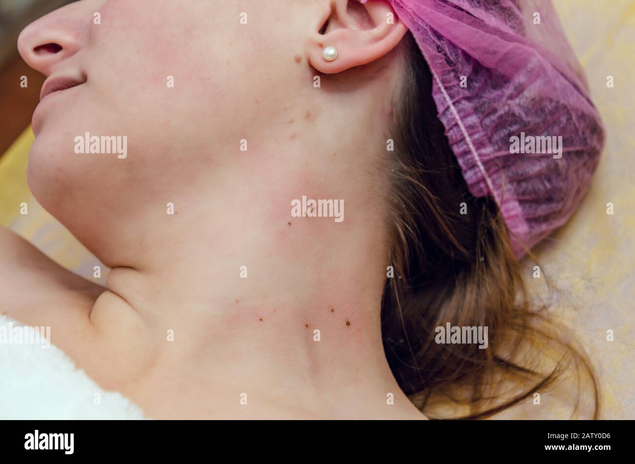 Retrait des papillomes sur le cou dans un salon de beauté. Banque D'Images