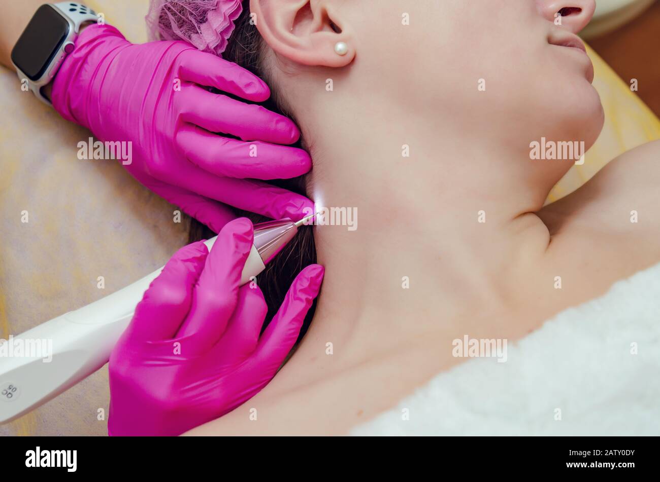 Retrait des papillomes sur le cou dans un salon de beauté. Banque D'Images