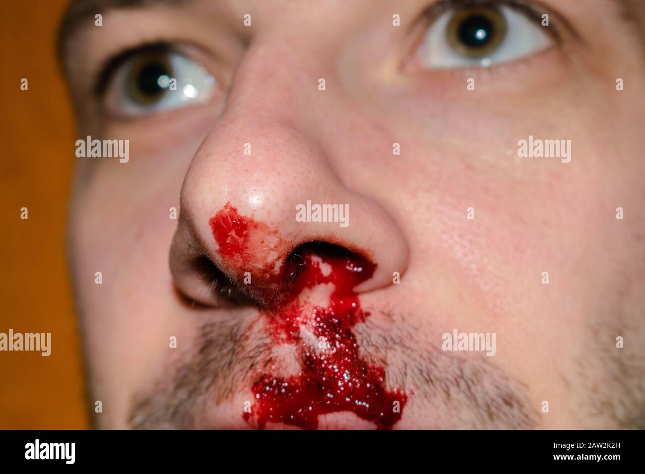 Il y a du sang du nez du gars. Le nez cassé et coloré est gros plan. Mise au point sélective Banque D'Images