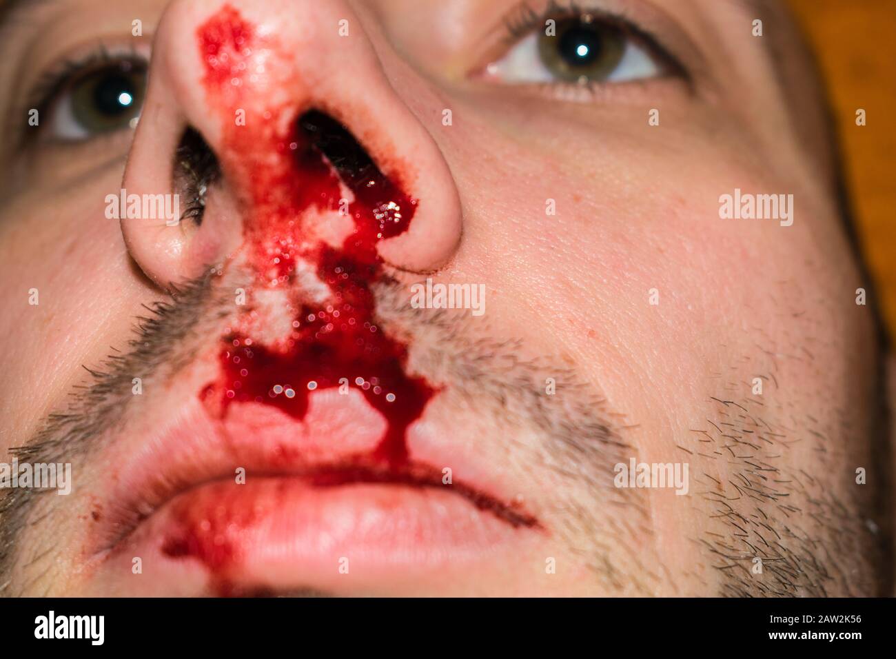 Nez cassé gros plan. Le sang d'un nez coule sur une personne et la bouche. Le visage de l'homme est dans le sang. Mise au point sélective Banque D'Images