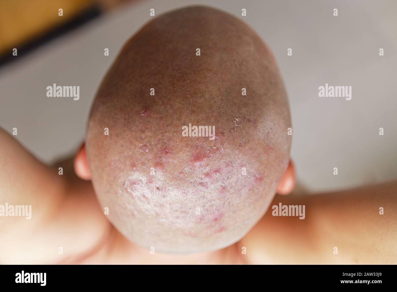 La tête rasée de l'homme avec la peau malade, l'acné et l'eczéma Banque D'Images