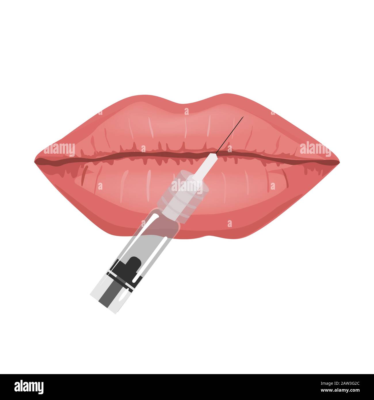 Concept d'injections de soutireuse lèvres, illustration vectorielle. Augmentation des lèvres. Injections d'acide hyaluronique Illustration de Vecteur