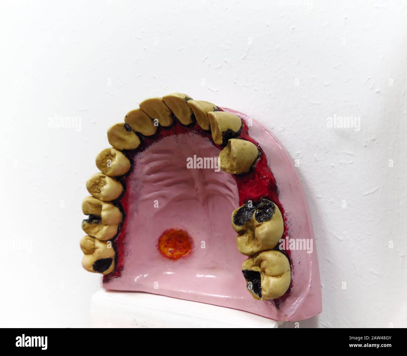 Modèle de bouche brute utilisé par les étudiants présentant des affections dentaires courantes Banque D'Images