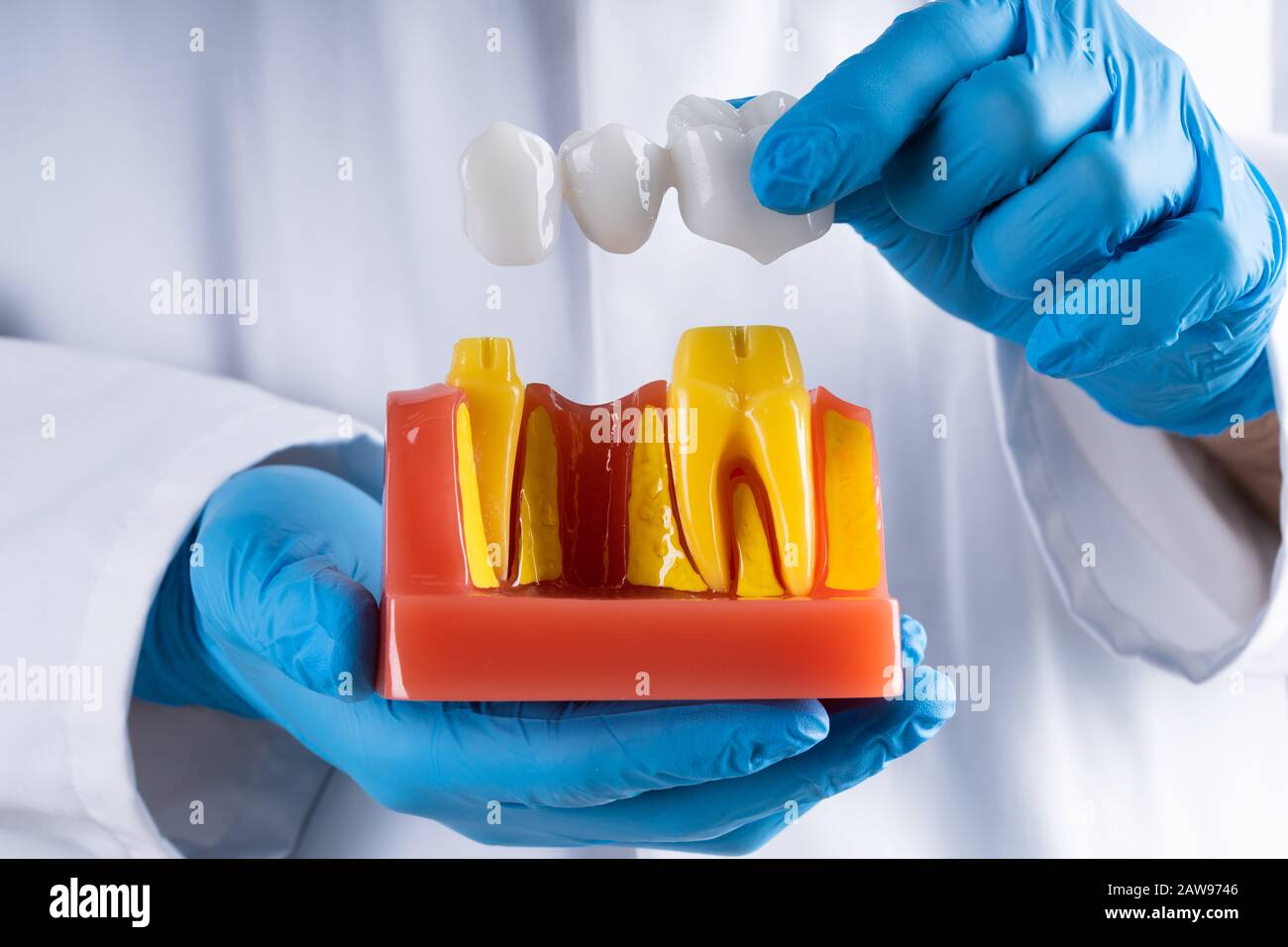 Dentiste en montrant des gants Modèle de pont dentaire Tooth Banque D'Images