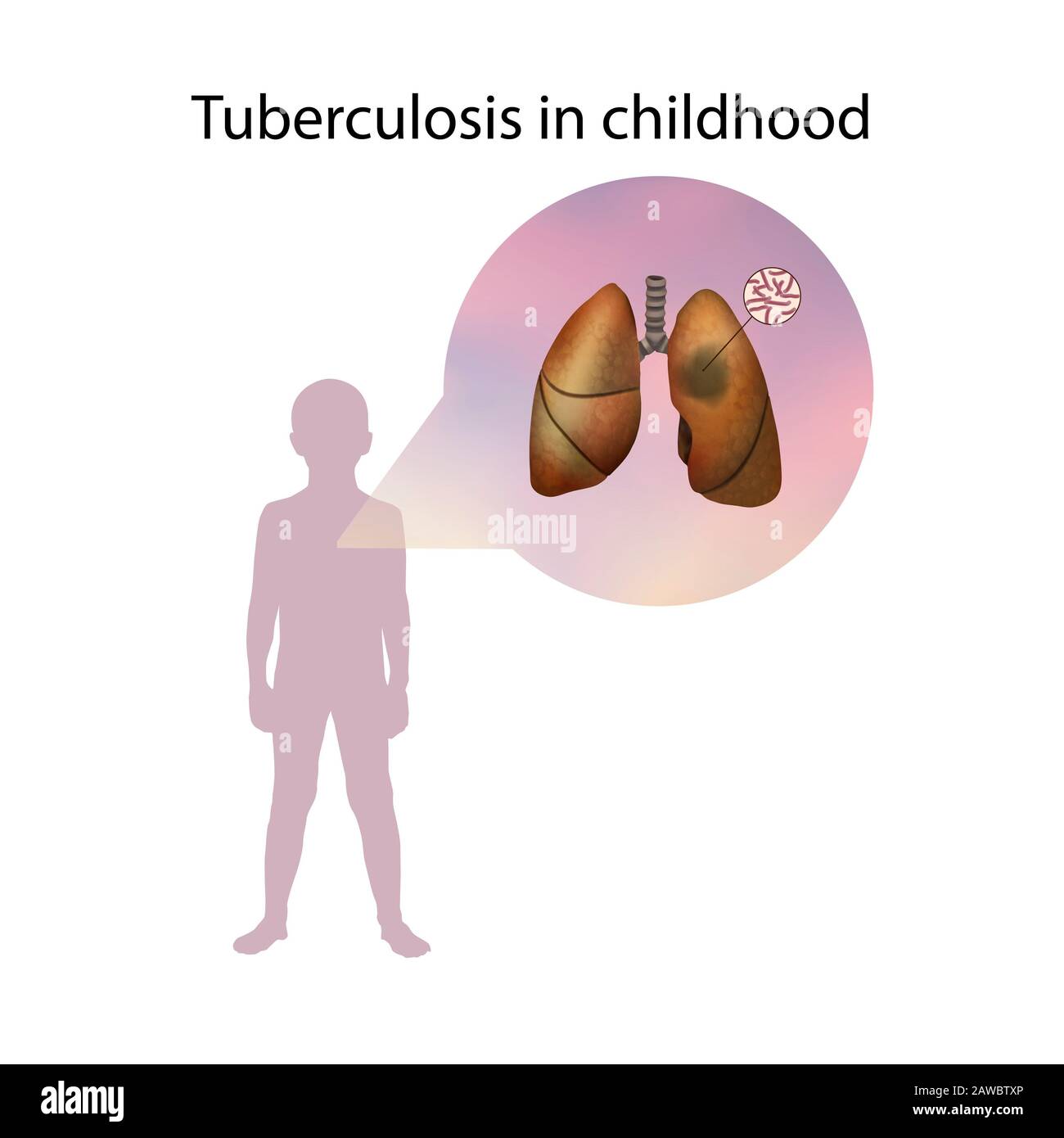 Tuberculose dans l'enfance, illustration Banque D'Images