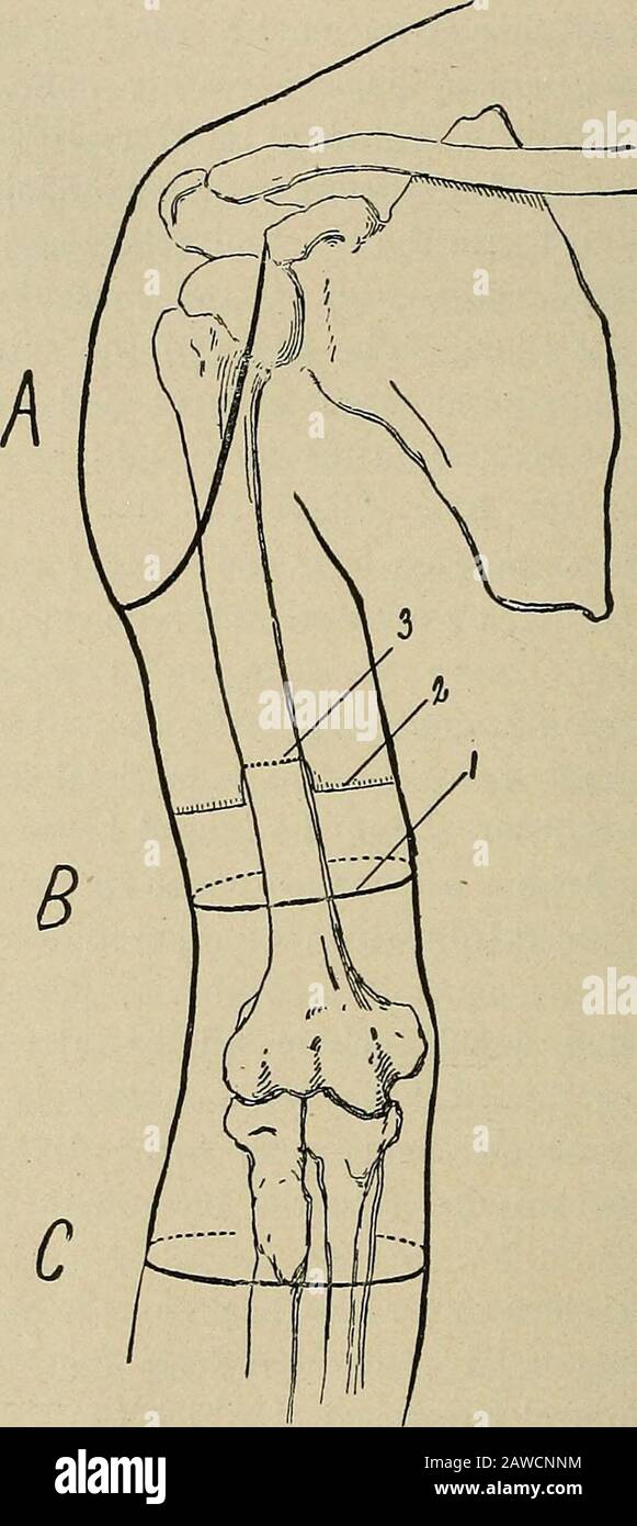 Chirurgie opératoire, pour étudiants et praticiens . ^ long pour couvrir l'ensemble de la souche. L'artère brachiale et les veines qui l'accompagnent se trouvent lyinganterior et à l'intérieur de l'os, et doivent être clampés et attachés;. Fig. 327.—Bras Droit, Aspect Antérieur. A, contour du deltoidlambeau latéral dans l'exarticulation au niveau de l'articulation de l'épaule ; B, amputation par le bras ; 1, incision par la peau ; 2, incision par le muscle ; 3, ligne de division par l'os ; C, incision pour l'exarticulation par l'articulation du coude (méthode cir-circulaire). Les nerfs médians et ulnaires, qui sont à proximité du thébrac Banque D'Images