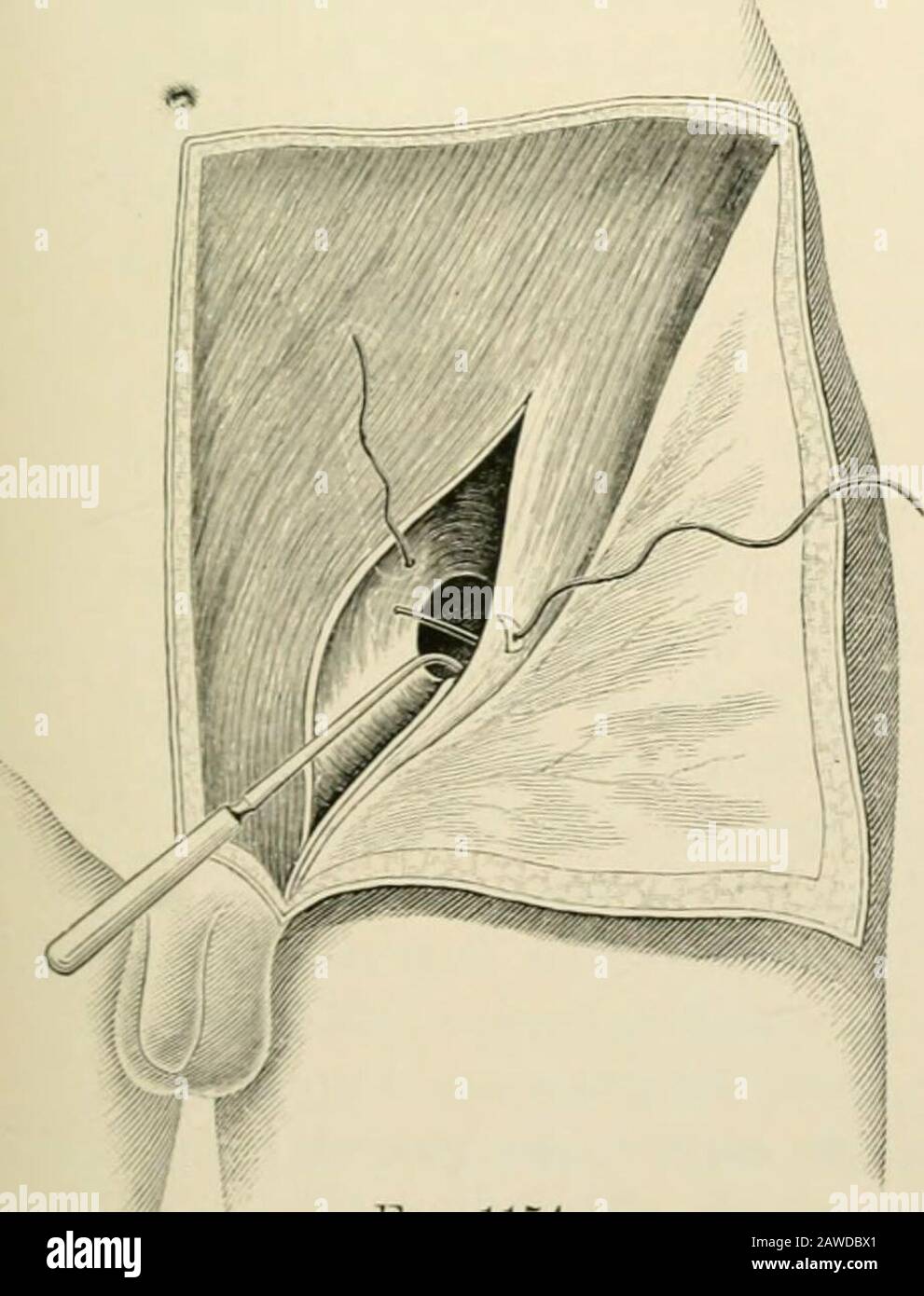 Chirurgie opératoire . Fig. 1153. Sapin... ] 152.—opération pour le traitement radical de la