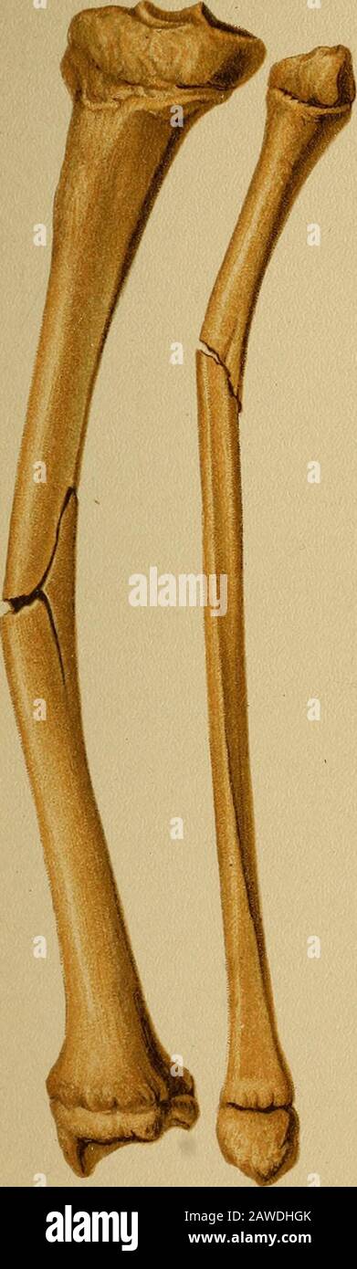 Atlas et épitome de fractures traumatiques et de dislocations . lecection.) fractures inales et spirales. Si l'os est divisé en un nombre de petits fragments, qui peuvent ou non être maintenus ensemble par le périostéum, nous parlons d'une fracture de l'orsplmtei^ed comminée. Il peut y avoir une fracture mi-tiple de l'os du thésame, comme une fracture à travers les parties supérieure, inférieure et intermédiaire ; et des fractures simpleques des os sev-eral, comme, par exemple, une fracture des deux os de l'avant-bras ou de la jambe, ou de divers os situés à une certaine détance l'un de l'autre. Il n'est pas sans importance de déterminer si l'afrature i Banque D'Images