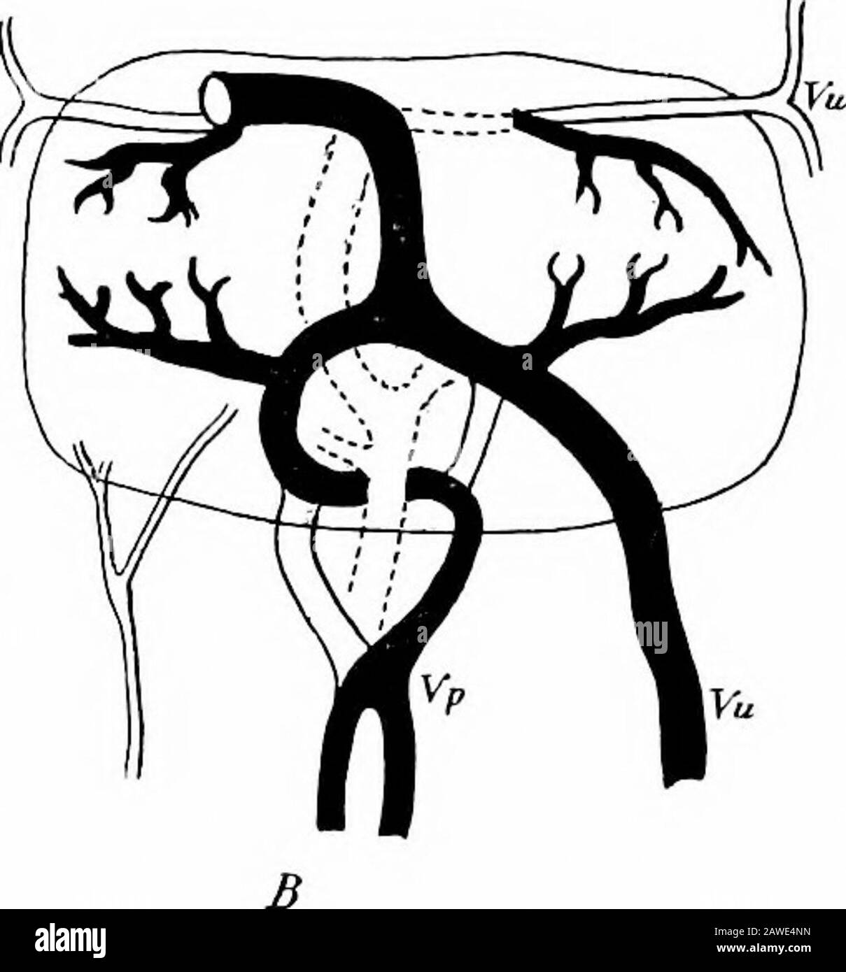 Le développement du corps humain; un manuel d'embryologie humaine . Fig. 149.—A, les trunks veineux d'Un Embryon op 5 mm. Vus de la surface Ventrale; B, Schéma Illustrant la transformation à L'État Adulte. VCD et Vcs, veine venae supérieure droite et gauche cava?; Vj, veine jugulaire; V.om, veine omphalo-mésentérique; Vc, veine vena; vu, veine ombilicale (partie inférieure); Vu1, veine ombilicale (partie supérieure); Vud et Vu, veines ombilicales droite et gauche (parties inférieures)— (SIH.) le sang du placenta, et semble être la con-tination directe du canal venosus (Fig. 149, C), dans quelleouvrir les veines hépatiques, Banque D'Images