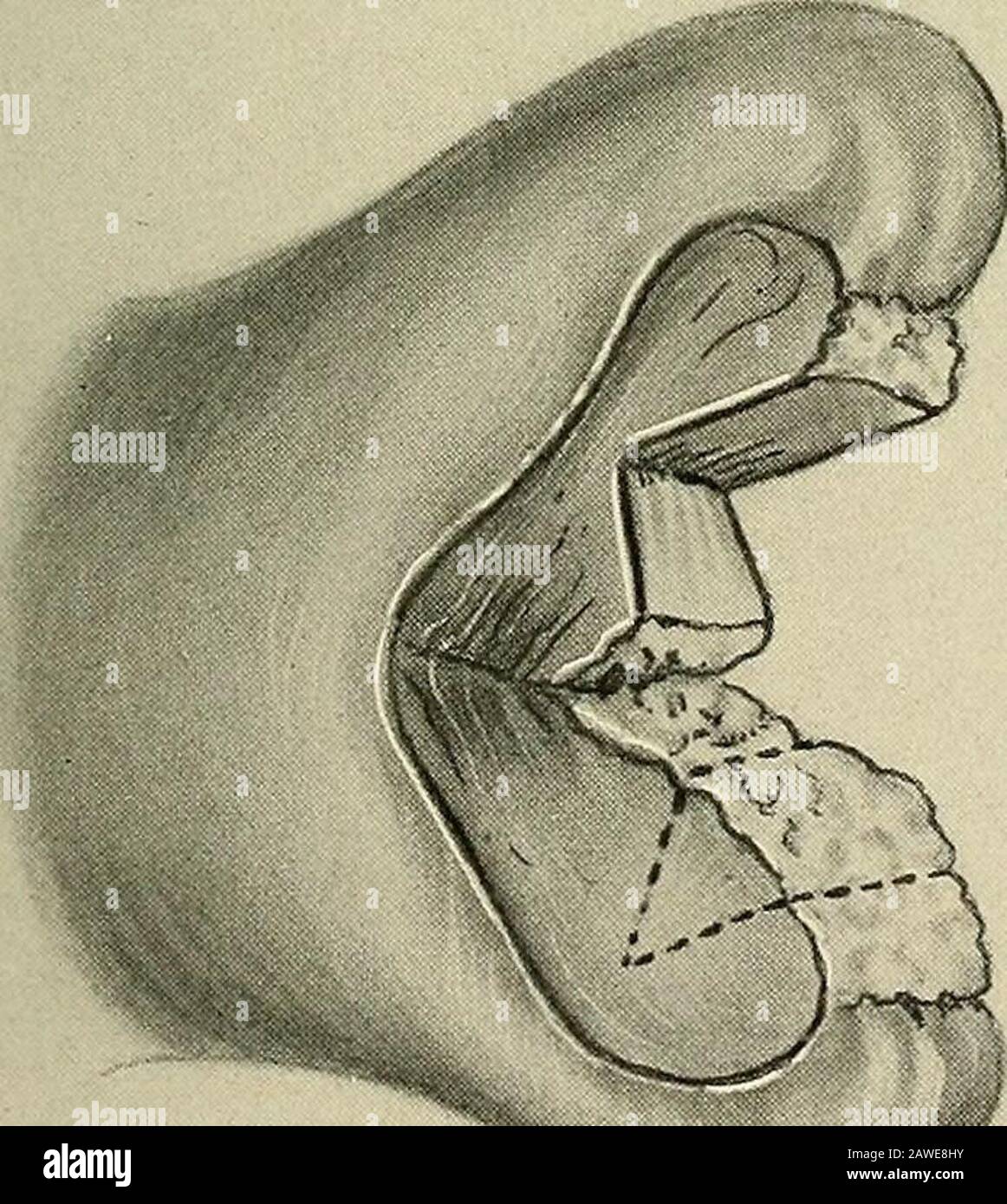 Gynécologie . Fig. 206.—trachéoplastie.Créer un nouvel angle lorsqu'une lèvre est plus longue que l'autre. Égale. Dans ce cas, l'extrémité de la lèvre la plus longue peut être amputée par une incision en forme de coin et les bords cousus avec le tube digestif. De cette façon, les lèvres se font facilement d'une longueur égale. Opérations SUR LE COL DE L'UTÉRUS 521 Parfois l'hypertrophie du tissu conjonctif sous-mucus le long du thecenter du canal est si grande que les zones denudées des côtés ne peuvent pas se rapprocher sans trop grande tension sur les points (Fig. 207). Pour éviter JR. V M | v. l^W y j /, Jk &gt;^T^ Fig. 207.—Ectropion du col utérin Banque D'Images