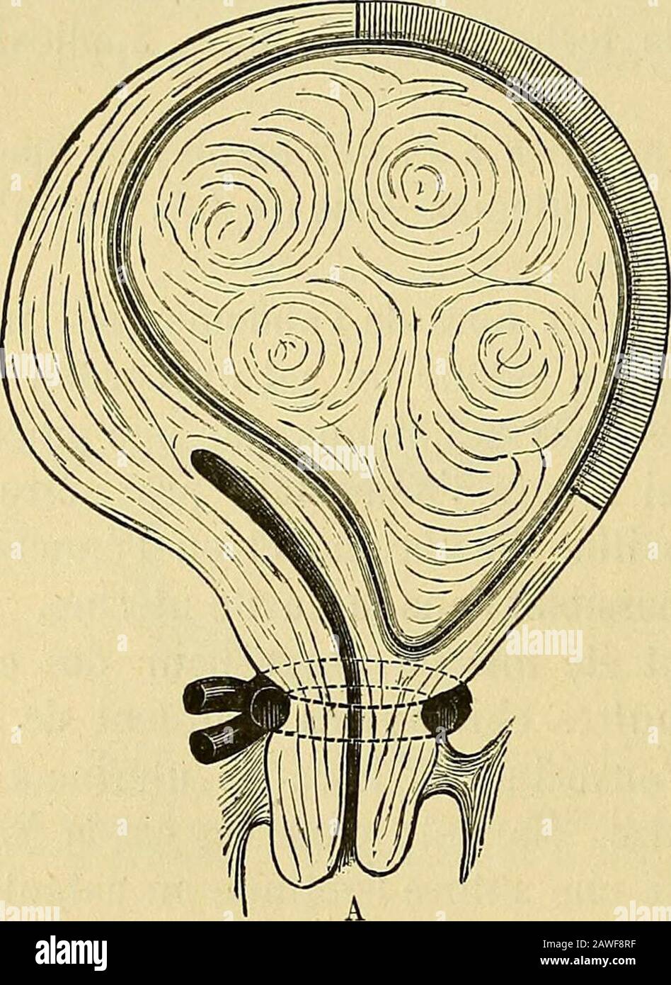 Sécurité de gynécologie clinique et économique . 2 Spencer Wells cité par Zweifel. Die Slielbehandlung bei Myomectomie, p. 82.Lopération de Spencer Wells est du 12 janvier 1863. 3 Martin, op. Cit., p. 287-88, et Burkhardt [Deutsche med. Wochenschr., 1880, n° 27). —Czempin. (Zeitschr. F. Geb. Und Gyn., Bd XIV, Heft 1, p. 255; Soc. gyn. De Berlin, octobre 2002). — Nagel. [Centralbl. Fur Gynàk., n° 51, 1886.) — Nagel. [Ibidem, n° 40, 1886). 4 Freuxd. Zur Entfernung submucoser Mynme durch die Lafarotomie [Centr. F. GYN.1888, n° 49). 302 LIVRE IV. Iodoforme. Sur le haut, du reste, diminue la caité rés Banque D'Images