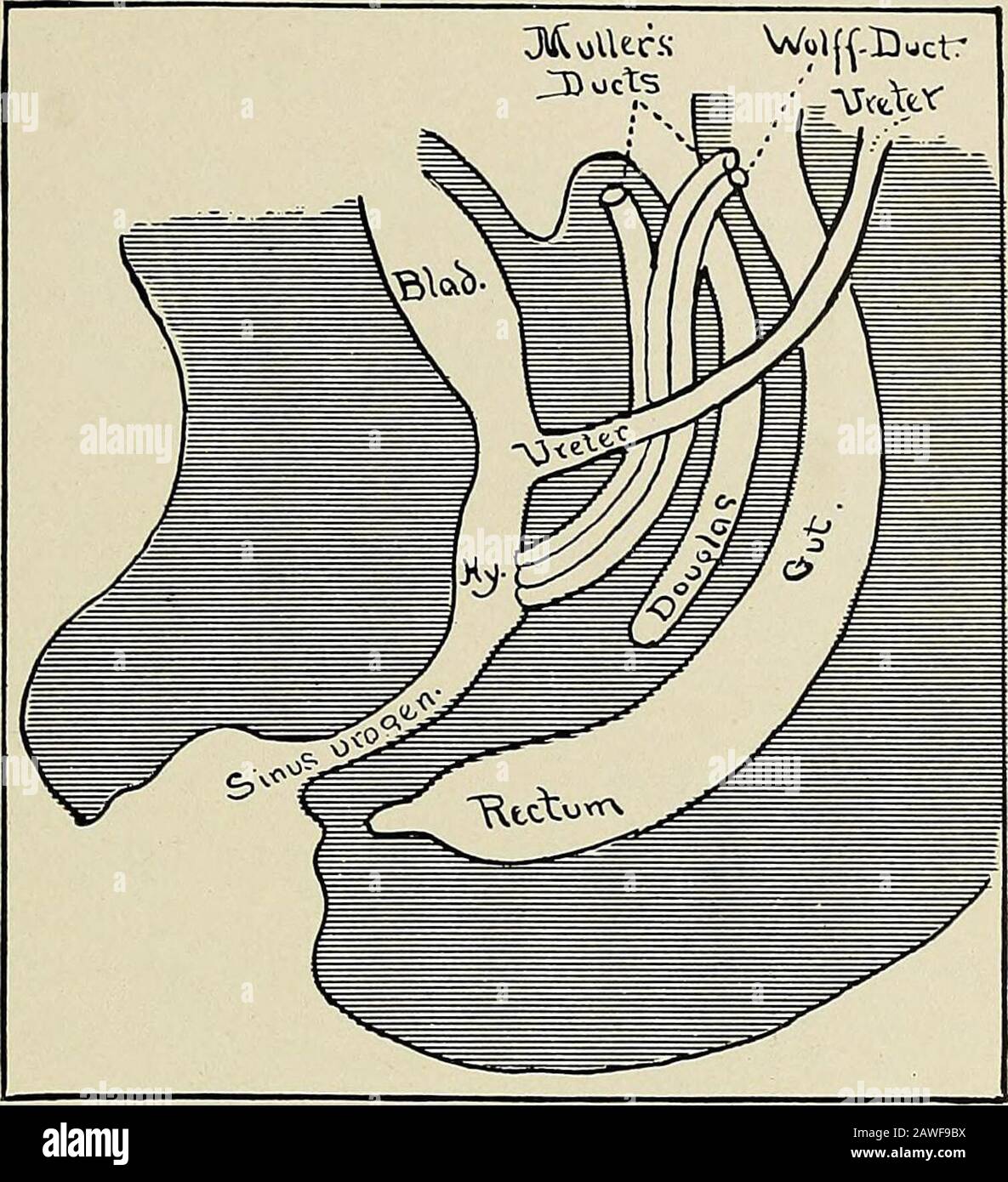 Gynécologie . Fig. 169.—le sinus urogenitalis est formé. L'uretère est vu sroutage du Wolffianduct. Les canaux de Mullers n'ont pas encore atteint le sinus urogenitalis, leur futureposition étant montré par les lignes pointillées (Pankow). Condition est appelée exstrophie de la vessie. L'extrusion de la vessie est une pression abdominale dueto qui force la paroi postérieure de la vessie à travers l'ouverture abdominale. DÉFAUTS DE DÉVELOPPEMENT 389. Fig. 170.—le sinus urogénital s'est brisé à travers la membrane de l'éloacal. L'intestin est encore fermé. Les conduits Miillerian ont atteint l'urogen Banque D'Images