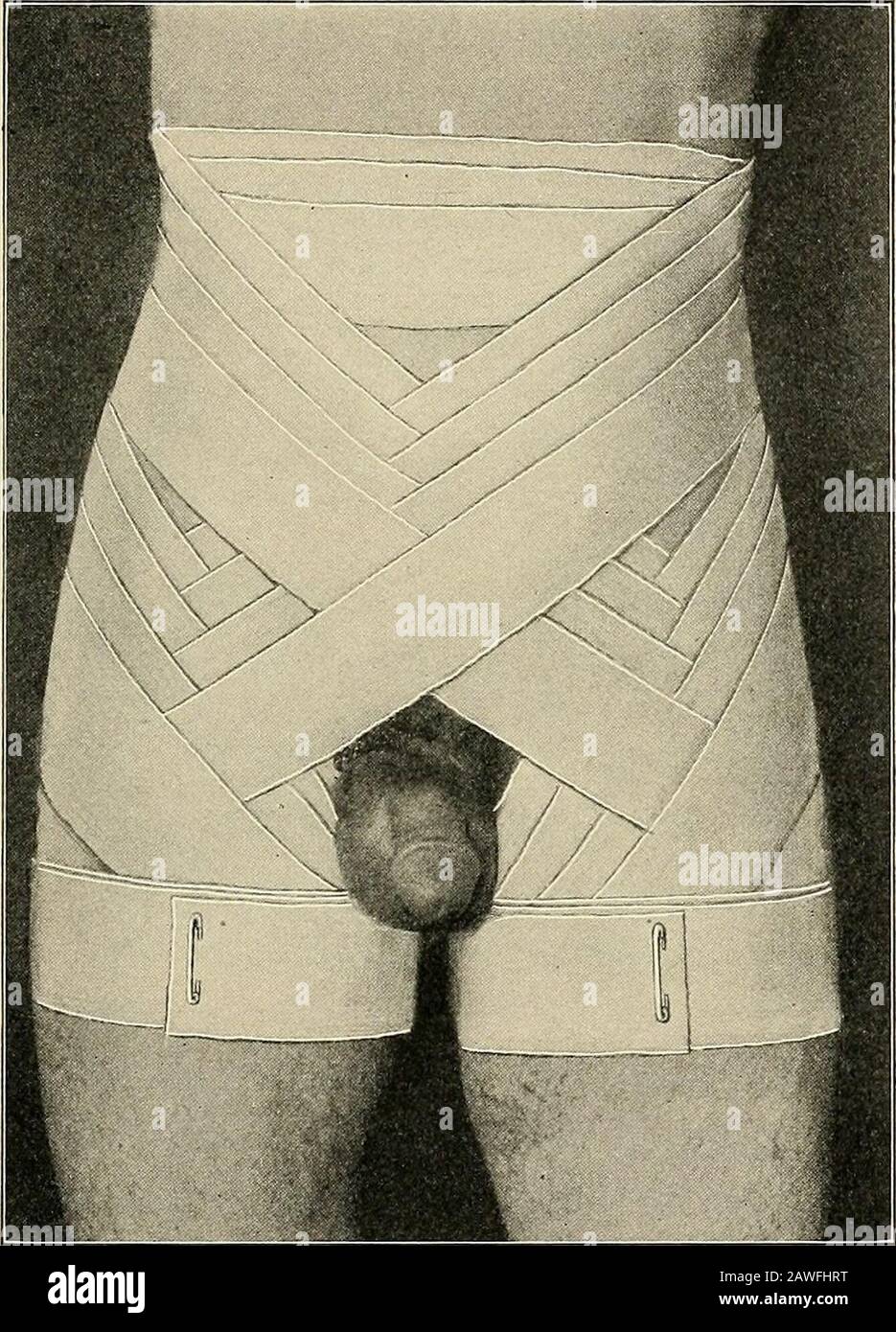 La salle d'opération et le patient ; un manuel de traitement pré- et post-opératoire . jusqu'à ce que les deux groins et le tiers supérieur des deux cuisses soient com-pletely couverts dans. Les tours circulaires autour de l'appui de boch s'étendent l'un l'autre et les virages circulaires autour de l'appui de thighsascend d'un tiers de leur largeur. Soit les tourniquets circulaires autour du corps, soit les virages circulaires autour des cuisses, soit les bothons peuvent être omis. Bandage 103 Spica décroissant Bandage des Deux Groins.—La spica descendante des deux groins (Fig. 80) est appliqué de la même manière asthe ascendant spica, à l'exception de l'oblique tu Banque D'Images