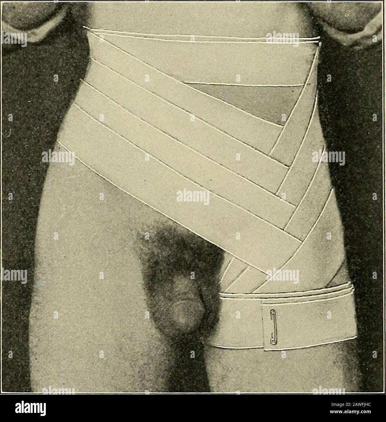 La salle d'opération et le patient ; un manuel de traitement pré- et post-opératoire . Fig. 77.—Ascending simple spica bandage de l'aine. (Fowlers Surgery.) 100 SALLE D'OPÉRATION ET LE PATIENT bas le plus possible dans la ligne médiane de la cuisse; il passe par-dessus la gioine à l'aspect latéral de l'os iliaque sur le sameside, et au-dessus de ceci dans une direction légèrement oblique à un point épigiac crête. Un tour circulaire est maintenant fait autour du corps juste au-dessus de la crête iliaque, comme dans le premier tour qui a fixé l'extrémité initiale. La spica tourne et les tours circulaires aroundla cuisse sont Banque D'Images