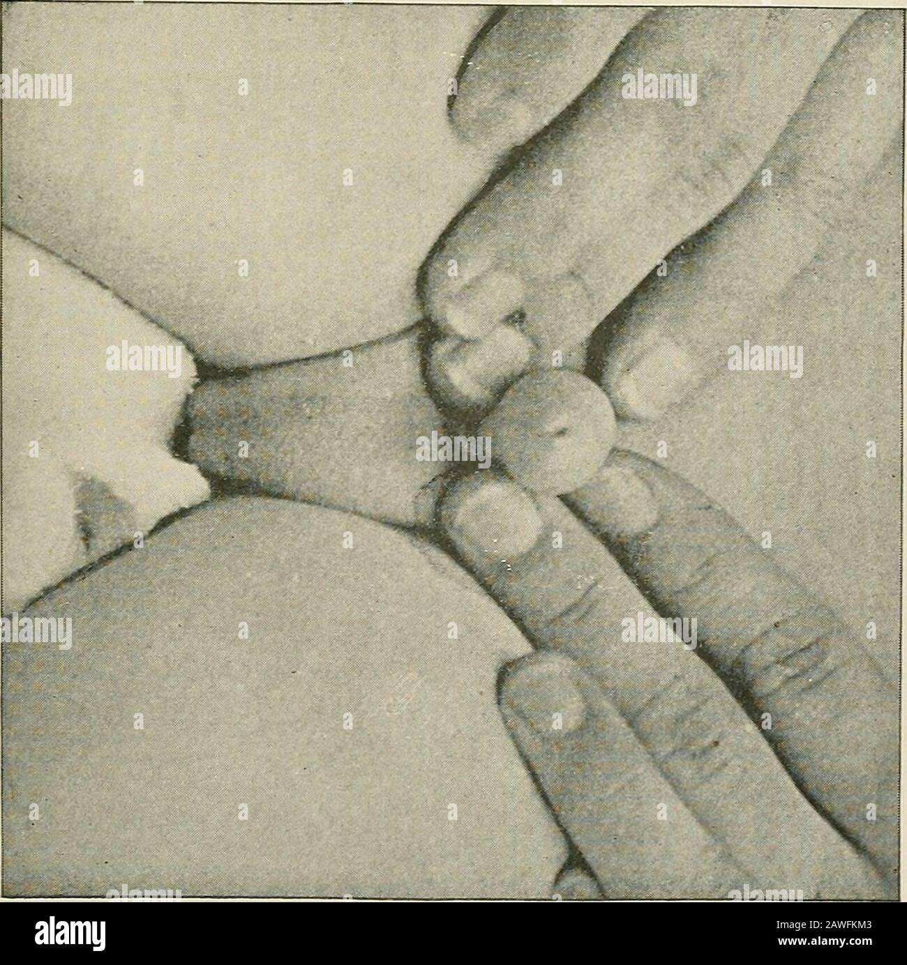 Prepuce Banque D Image Et Photos Alamy