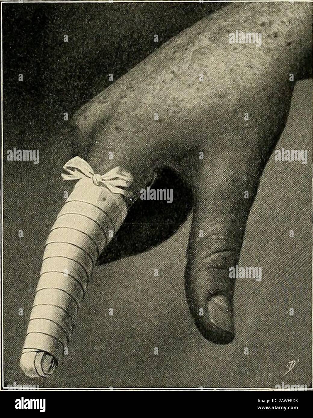 La salle d'opération et le patient ; un manuel de traitement pré- et post-opératoire . Fig. 66.—bandage en Spica du pouce (chirurgie Fowlers.) du tour précédent. Un tour circulaire est fait à la base du doigt et le bandage est porté au moyen de virages en spirale toit commençant-pont au niveau de la liaison phalangale centrale. Du. Fig. 67.—bandage en spirale du doigt. (Fowlers Surgery.) surface postérieure de cette articulation un virage récurrent est maintenant passseddirectement sur l'extrémité du doigt à la surface antérieure de la salle D'OPÉRATION 92 AXD L'articulation PATIEXT, les doigts des opérateurs de tlie tenant la main gauche Banque D'Images