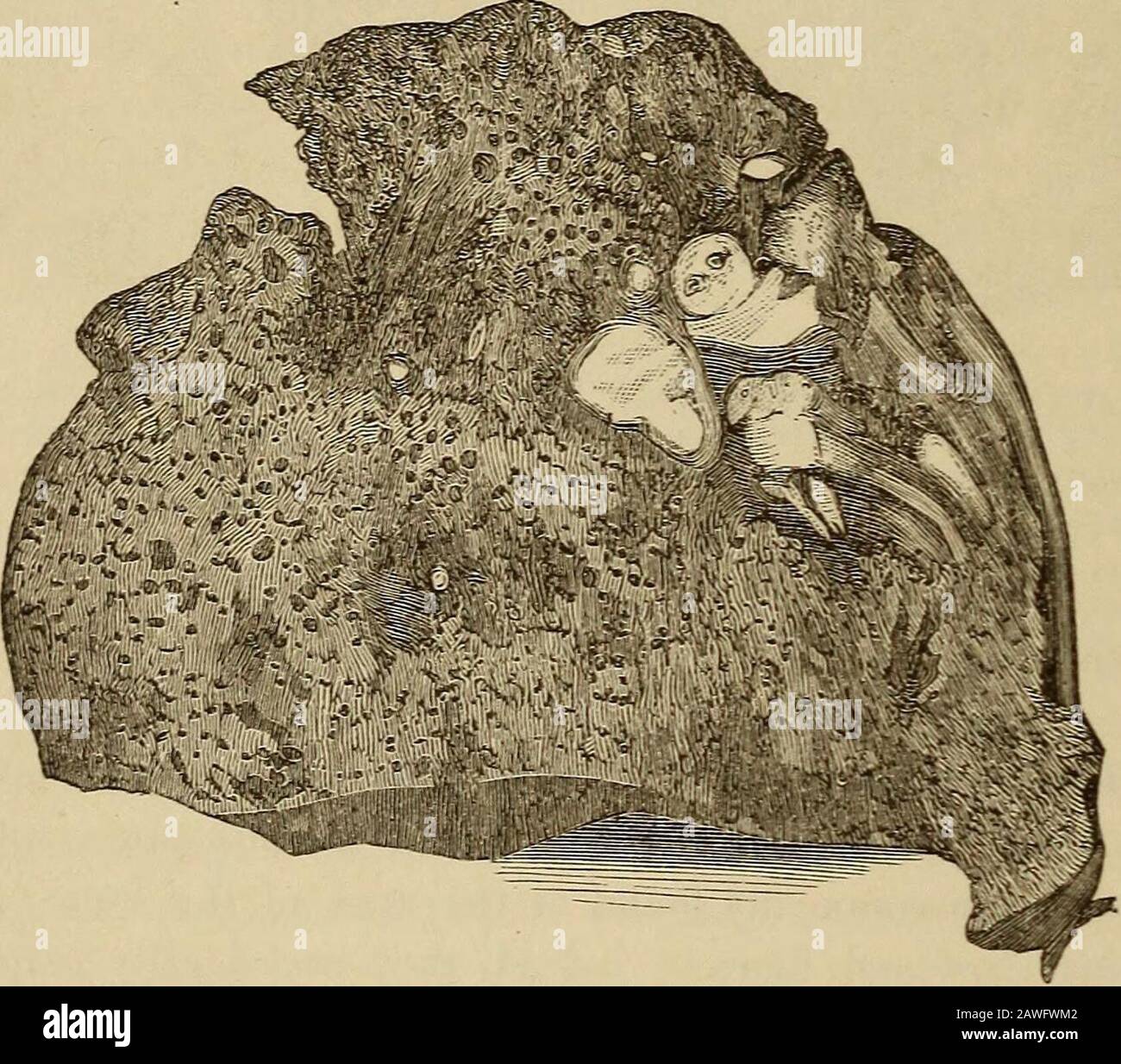 Tuberculose pulmonaire : sa pathologie, sa nature, ses symptômes, son diagnostic, son pronostic, ses causes, son hygiène et son traitement médical . horités comme curatives. Voici une TUBERCULOSE de 22 PULMOXARV. Poumon pris de la poitrine d'un homme qui, depuis plusieurs années, était censé avoir la tuberculose pulmonaire, mais a récupéré sa santé, et a été tué il y a quelques jours par un accident sur un train ferroviaire. ITIS le poumon droit. À l'oeil, il semble naturel, à l'exception de la partie supérieure de la région ; ici il semble rétréci et assez noir, comme si l'ithade était l'emplacement de certains changements structurels. Sur la pression itfermement nous trouvons plusieurs dur. Banque D'Images