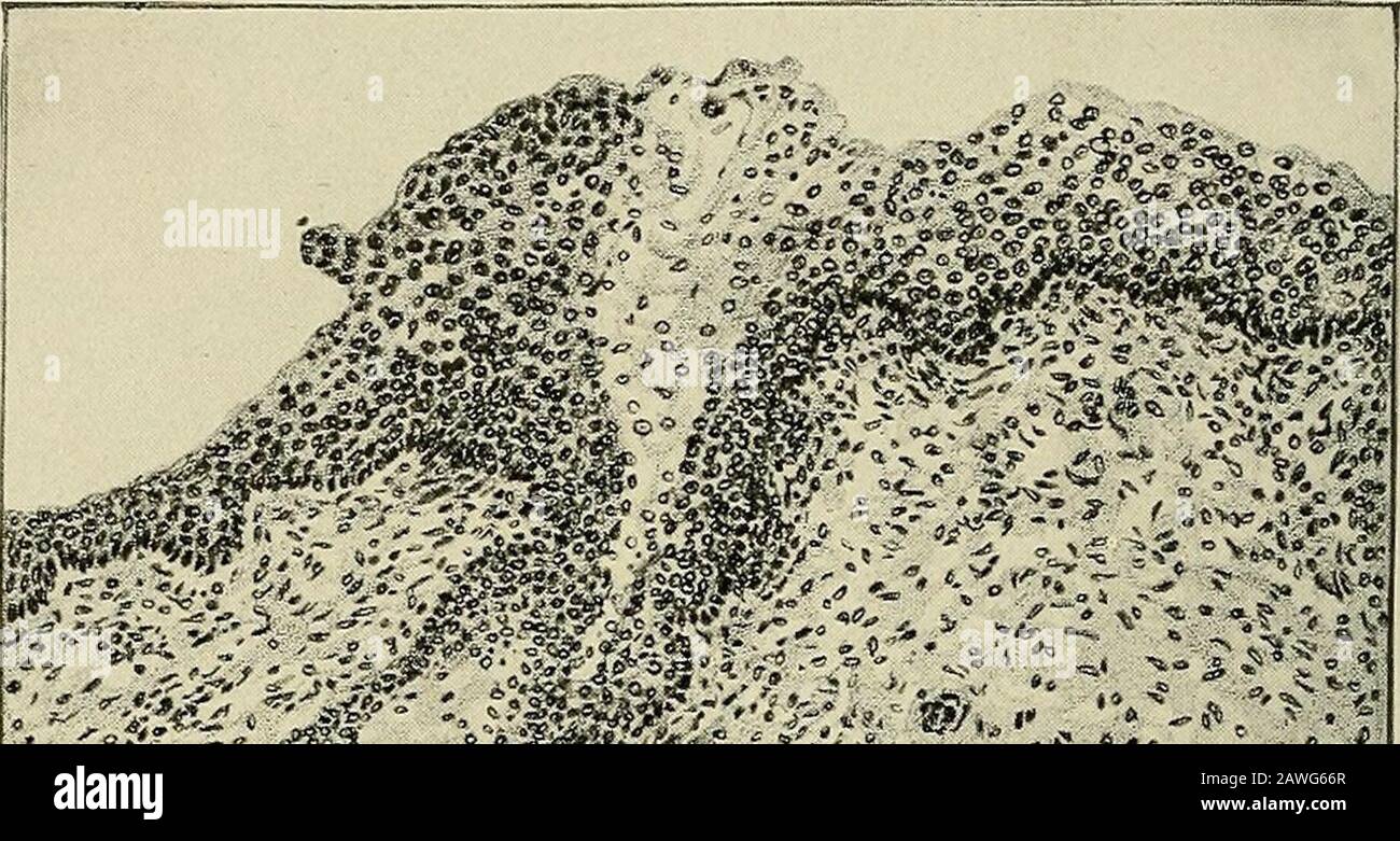 Gynécologie . orpus lutéum. RimMTCT COUCSEL Fig. 149.—Cyst Dermoid.Très faible puissance. Section du petit kyste dermoïde illustrée dans la dernière mise en plan. Ceci montre le théso-appelé plug du kyste dermoïde s'étendant dans la cavité. Il est recouvert de squamousepithlium stratifié sous lequel sont des glandes sébacées et des follicules pileux. Un follicule pileux peut être vu à gauche du milieu de la fiche près de sa surface. C'est une étape très précoce dans le développement d'un dermoidcyst. Ils sont rarement trouvés si petits. 349 350 LA croissance GYNÉCOLOGIQUE se trouve près de la surface et apparaît sous forme d'excréments tubéreux ou papillaires Banque D'Images