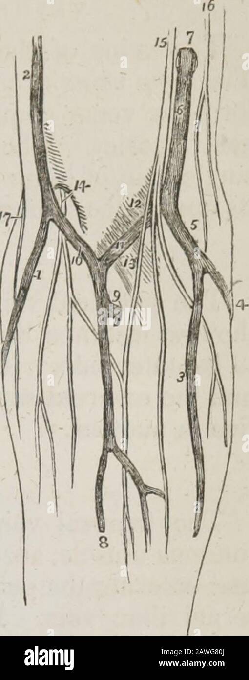 Un système d'anatomie humaine, général et spécial . le coude du coude qu'il reçoit un branchdes veines profondes, et se divise en twobranches, le céphalique médian et médianbasilique. La veine céphalique Médiane, généralement thésmaller des deux, passe obliquement vers l'extérieur, dans la rainure entre les biceps et le longus supi-nator, pour rejoindre la veine céphalique. Les Thebranches du nerf cutané externe lui passont. La veine basilique Médiane passe l'obliquelyvers l'intérieur, dans la rainure entre les teres biceps et les rayons du pronateur, et se termine dans la veine labasilique. Cette veine est traversée par un ou deux filaments du Banque D'Images