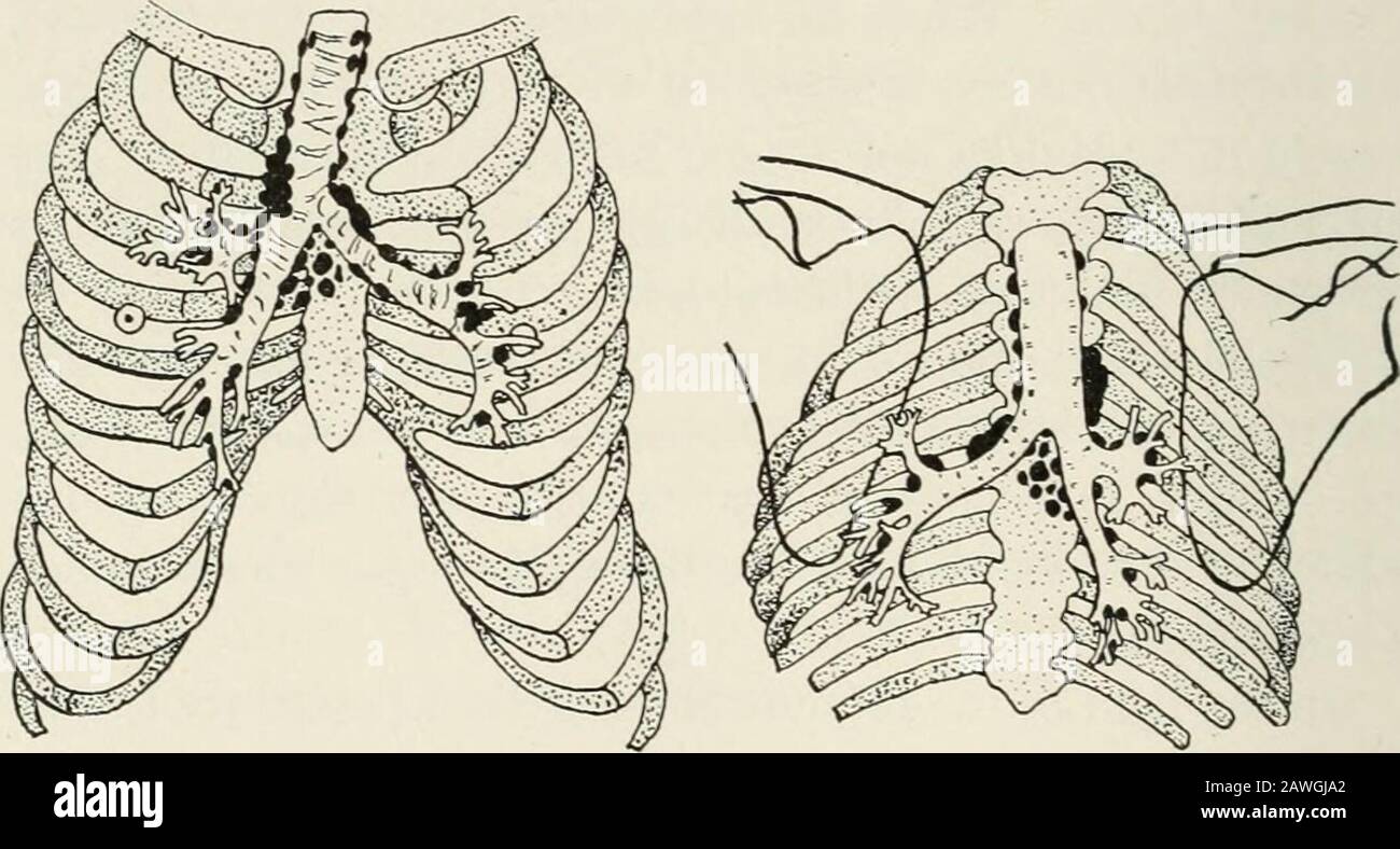 Nouveaux concepts dans le diagnostic et le traitement : médecine physico-clinique, l'application pratique de la théorie électronique dans l'interprétation et le traitement de la maladie, avec une annexe sur les nouveaux faits scientifiques . ^ du coeur, les vaisseaux sanguins et le thymus peuvent être exclus. La partie inférieure ou médiane du poumon est dans la majorité des cas, le siège de l'inoculation pri-mary chez les nourrissons et les jeunes enfants, le butthat chez les sujets de plus de 10 ans comme chez les adultes, c'est le sommet qui est généralement impliqué (déductions radiographiques, LFous, Paris). Fig. 51.—diagrammes montrant les relations anatomiques des bronches Banque D'Images