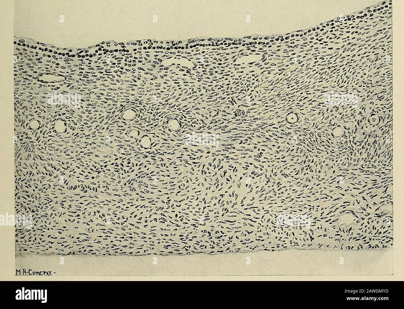 Gynécologie . Fig. 122.—Dégénérescence kystique du dessin ovarien.Macroscopique d'une section d'un ovaire entier. Dans le cortex se trouvent plusieurs petits kystes qui se sont révélés microscopaquement être des kystes de follicules graafiens. Sur la gauche se trouvent des kystes avec seulement de minces partis entre eux, suggérant comment, à mesure qu'ils deviennent plus grands, la partition s'émouille, se rompt, et permet à deux kystes de se coalesce en un seul. Fig. 123.—kyste D'un Follicule graafien.faible puissance. Au sommet se trouve la doublure du kyste composée d'une à plusieurs couches de cellules dérivées du souvenir granulosa du follicule. Cela se trouve sur le connecteur-t Banque D'Images