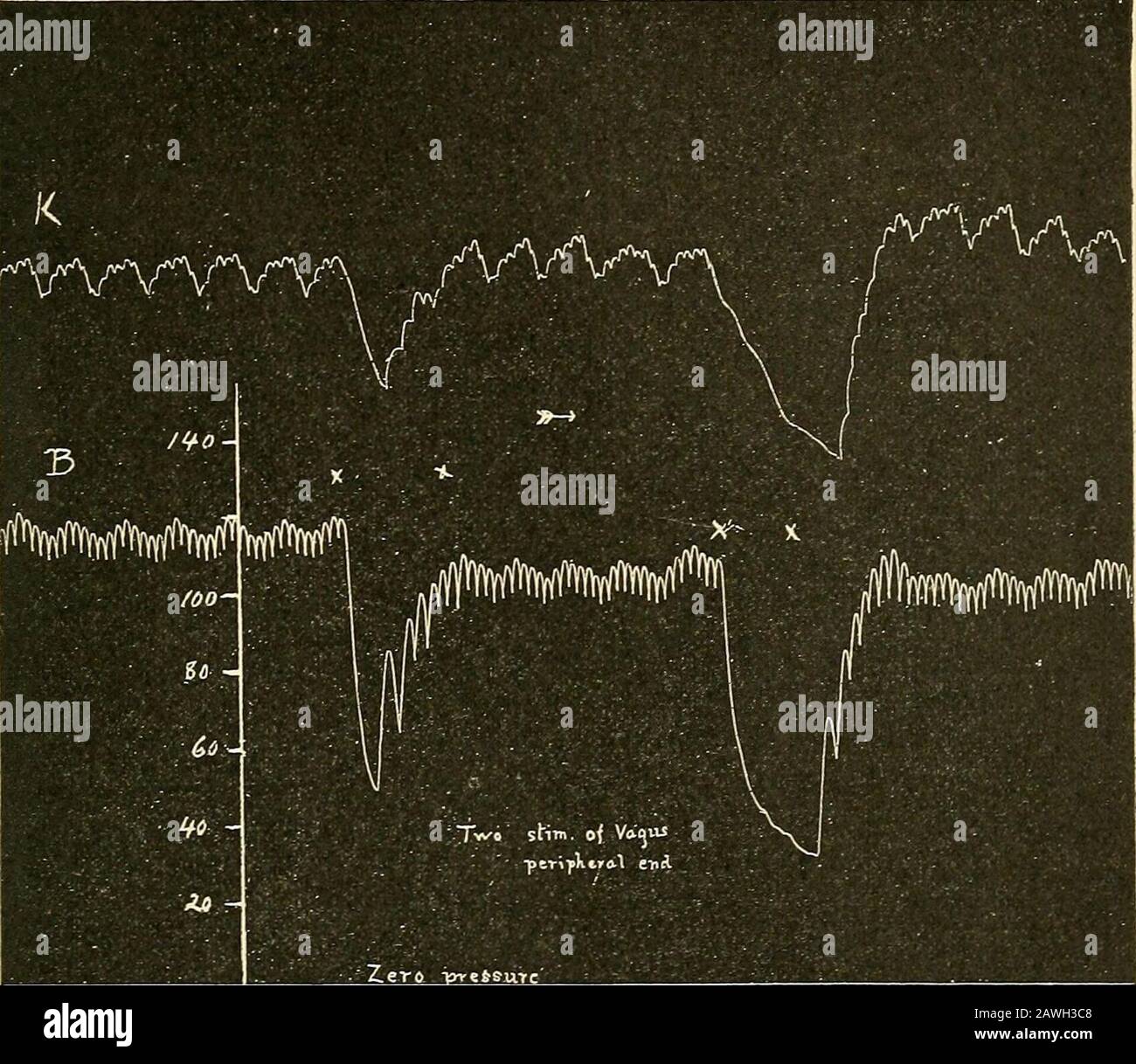 Un livre de textes sur la physiologie pour les étudiants en médecine et les médecins . Fig. 239.—pour montrer l'inhibitiondu cœur des terrapins en raison de la stimulation du nerf vagus. Le palpage supérieur (/) enregistre les contractions de l'auricule gauche; le signe inférieur (//) les clictions du ventricule. La vaguswas stimulée trois fois, eachchamber arrivant à un arrêt complet.Sur l'élimination de la stimulation, il va benpted que les contractionsauriculaires augmentent progressivement à leur normale, alors que les contractionsventriculaires commencent à pleine force. LES NERFS CARDIAQUES. 575 en particulier dans la terrapin, les fibres inhibitrices peuvent être Banque D'Images