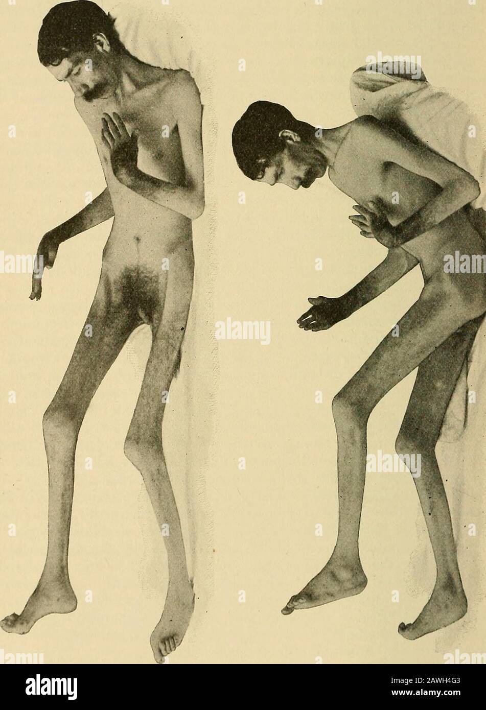 Un système de médecine pratique . viennent velouté, doux, et sont érodés et absorbés. Beaucoup de casesare sec, mais l'épanchement de synovia est aussi commun, et si la presentit est un phénomène précoce et peut disparaître plus tard. Hoppe-Seyler *a trouvé un excès de mucine dans le liquide synovial. Les os.—À Mesure Que les surfaces cartilagineuses disparaissent, les extrémités oppostingales des os longs deviennent arrondies, lisses, extrêmement dures, andbrillantes ou éburnées, ressemblant à de l'ivoire poli. Une absorptionsimilaire peut avoir lieu dans les extrémités des os, mais à un degré de chasse.l'urate de sodium n'est pas trouvé comme il est dans le gout. La prolifération de Banque D'Images