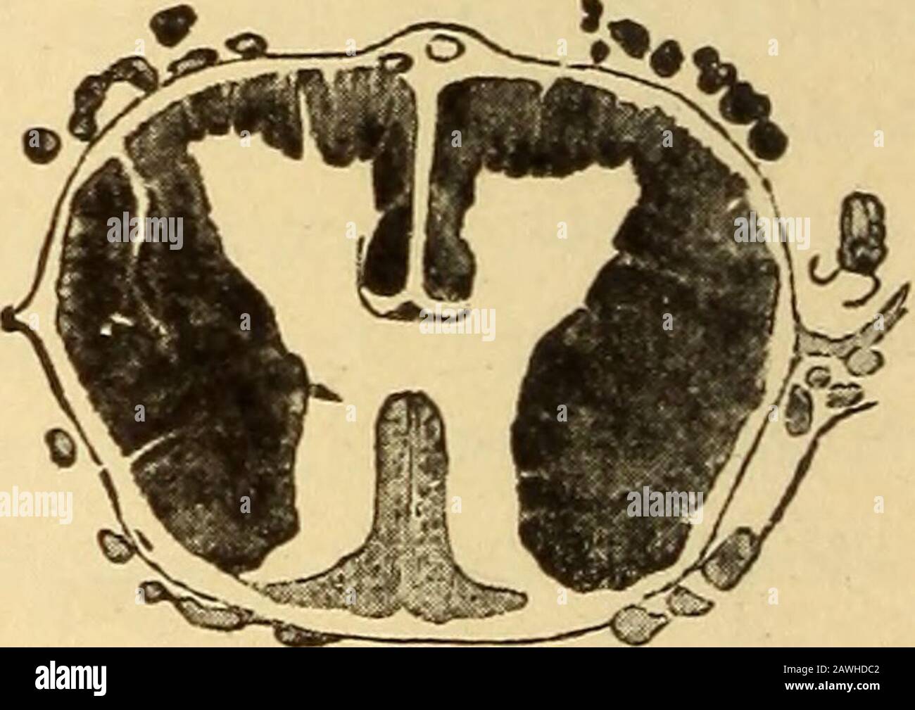 Maladies du système nerveux .. . Fig. 103.—^Maladie Tabétique Du Cordon Cervical.(Après Oppenheim.). Fig. 104.—maladie Tabétique du cordon lombaire. (Après Oppenheim.) Banque D'Images