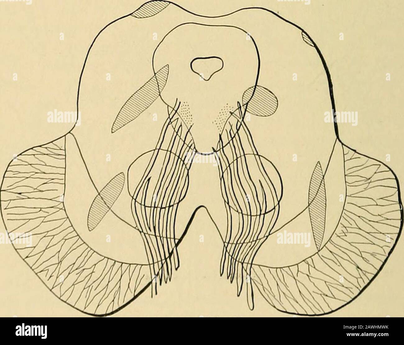 Un système de médecine pratique . Identique à la Fig. 53. Volées, très rarement tout au long de leur épaisseur entière, mais généralement Gowers. ^ Anniud de (HE Universal Medical Scienten, 1895, vol. ii. A-68. SCLÉROSE EN PLAQUES. 413 seule une partie du nerf est grise. Les cellules sclérotiques sont un peu présentes dans les racines du nerf rachidien. Le microscope montre dans les cellules scle-rotic une augmentation des éléments du tissu conjonctif, l'épaississement des parois des vaisseaux sanguins plus petits, et la destruction de la substance blanche des fibres nerveuses, avec souvent les cylindres de l'axe re-maining. La préservation des cylindres d'axe Banque D'Images